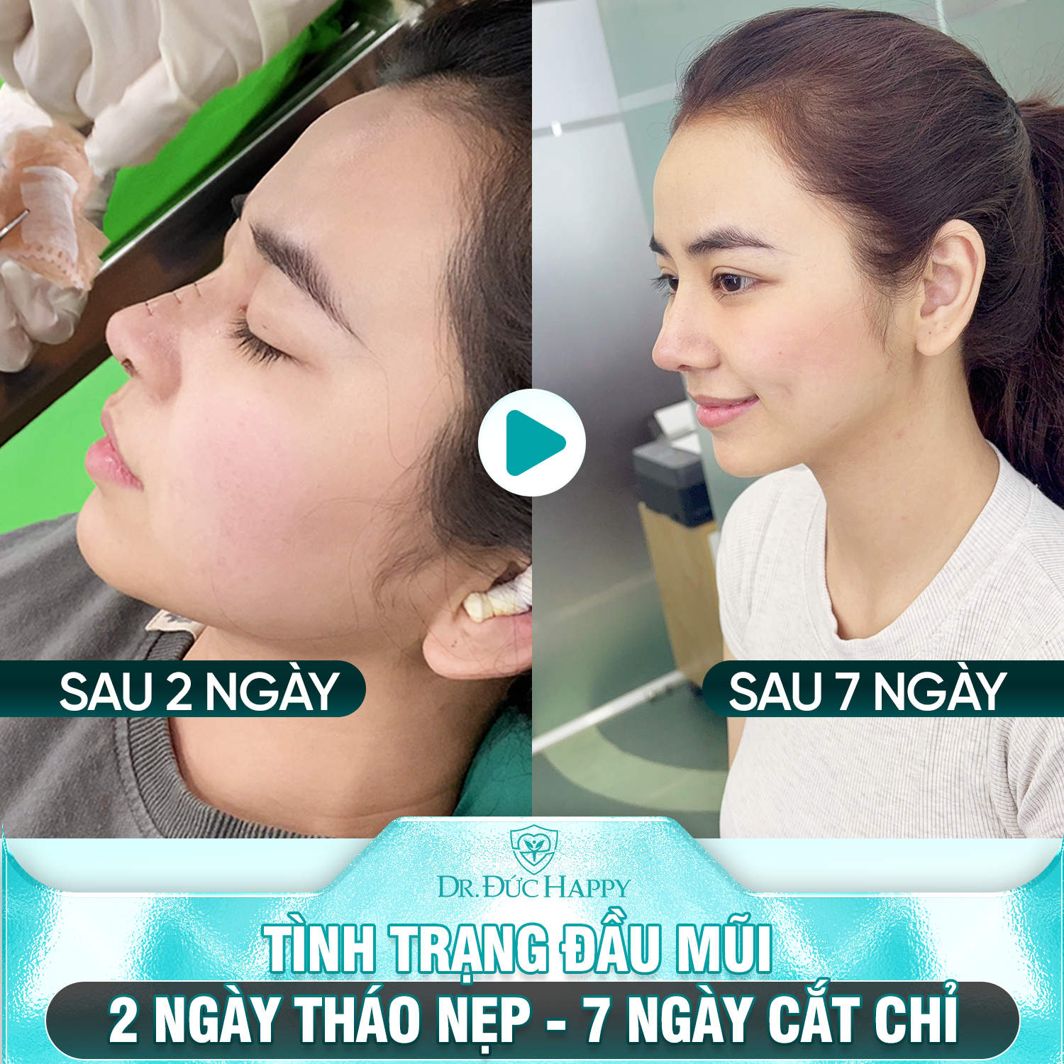 tình trạng đầu mũi trước và sau 2 ngày tháo nẹp - 7 ngày cắt chỉ