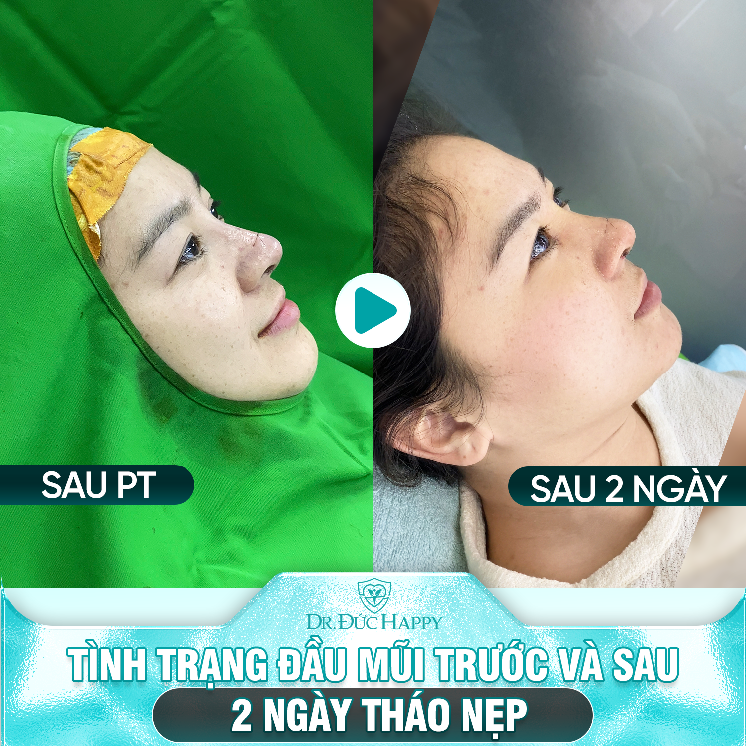 Tình trạng dáng mũi trước và sau 2 ngày tháo nẹp