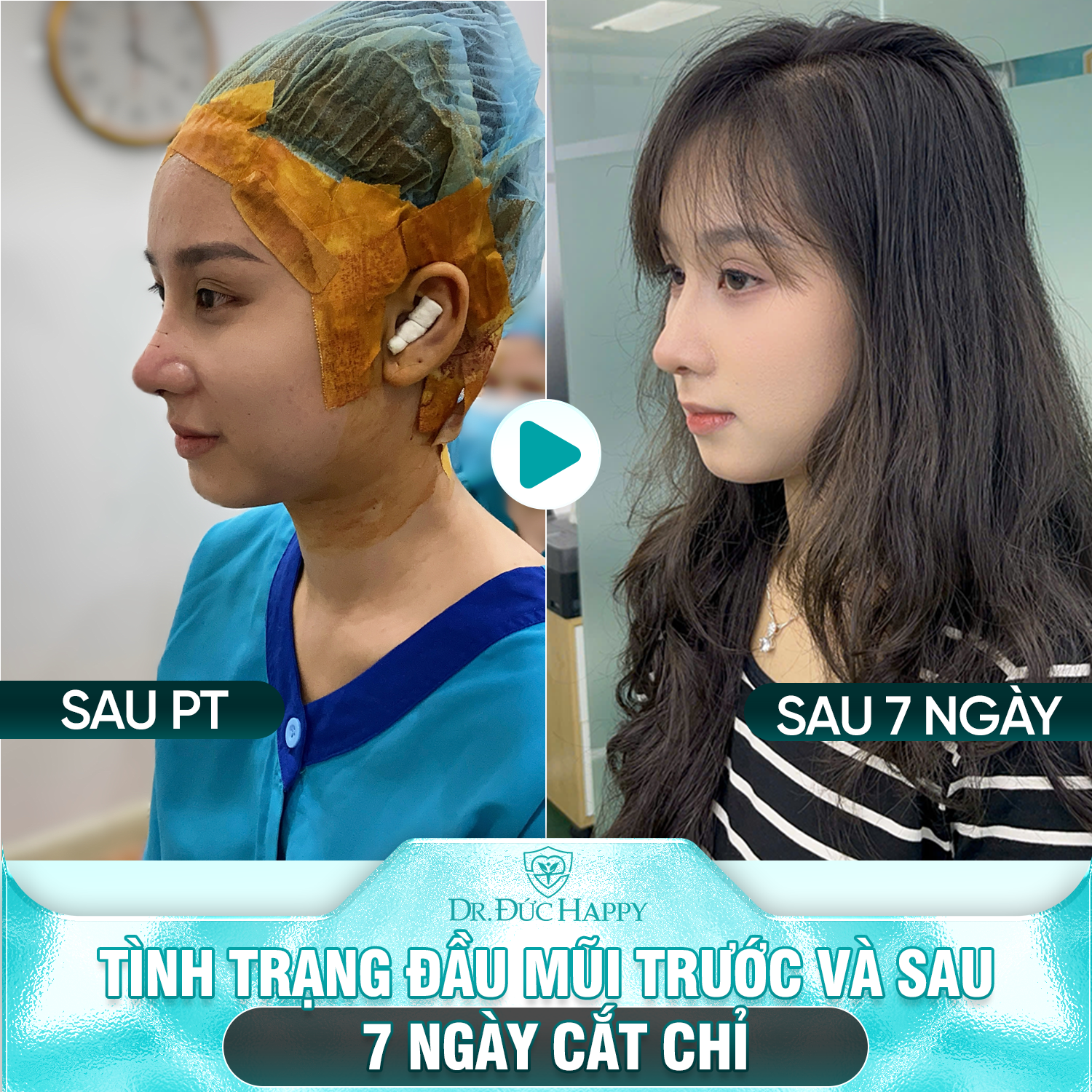 Tình trạng dáng mũi trước và sau 7 ngày cắt chỉ