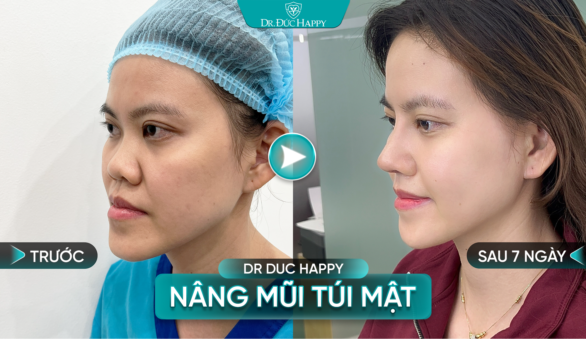 Nâng mũi túi mật nữ hoàn thiện sau 7 ngày