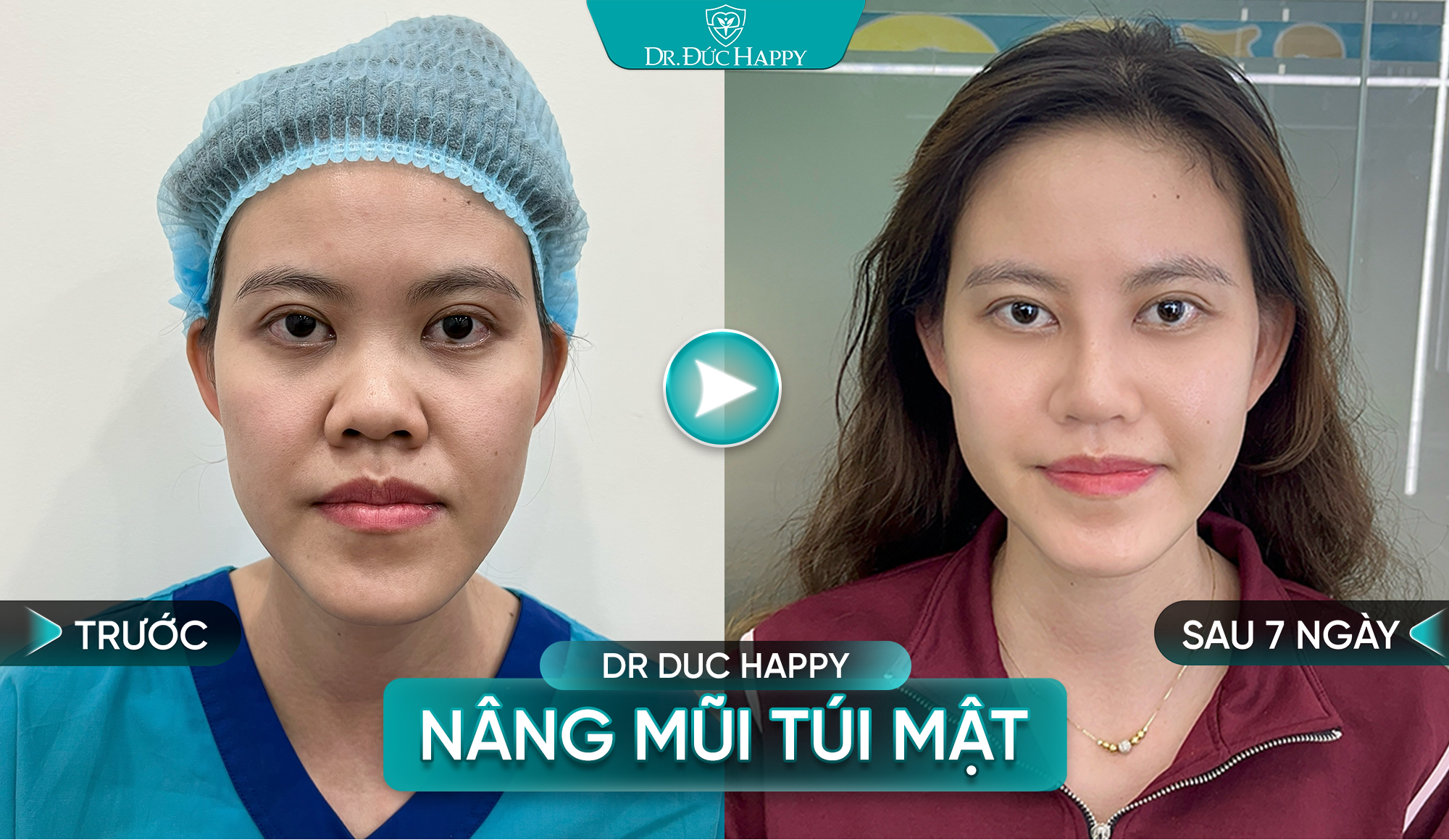 Nâng mũi túi mật nữ sau 7 ngày