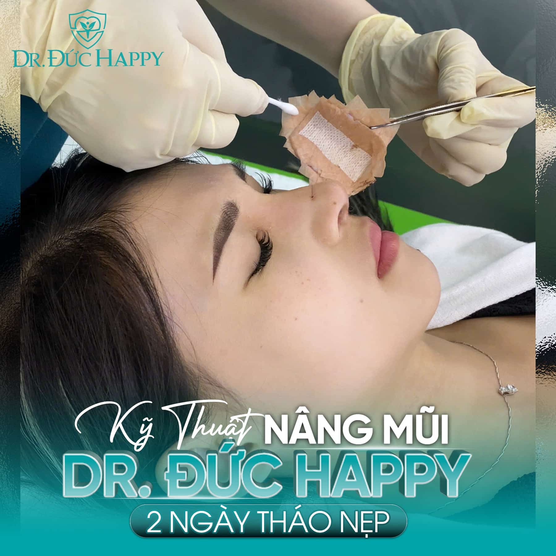 Kỹ thuật nâng mũi vi phẫu - 2 Ngày tháo nẹp