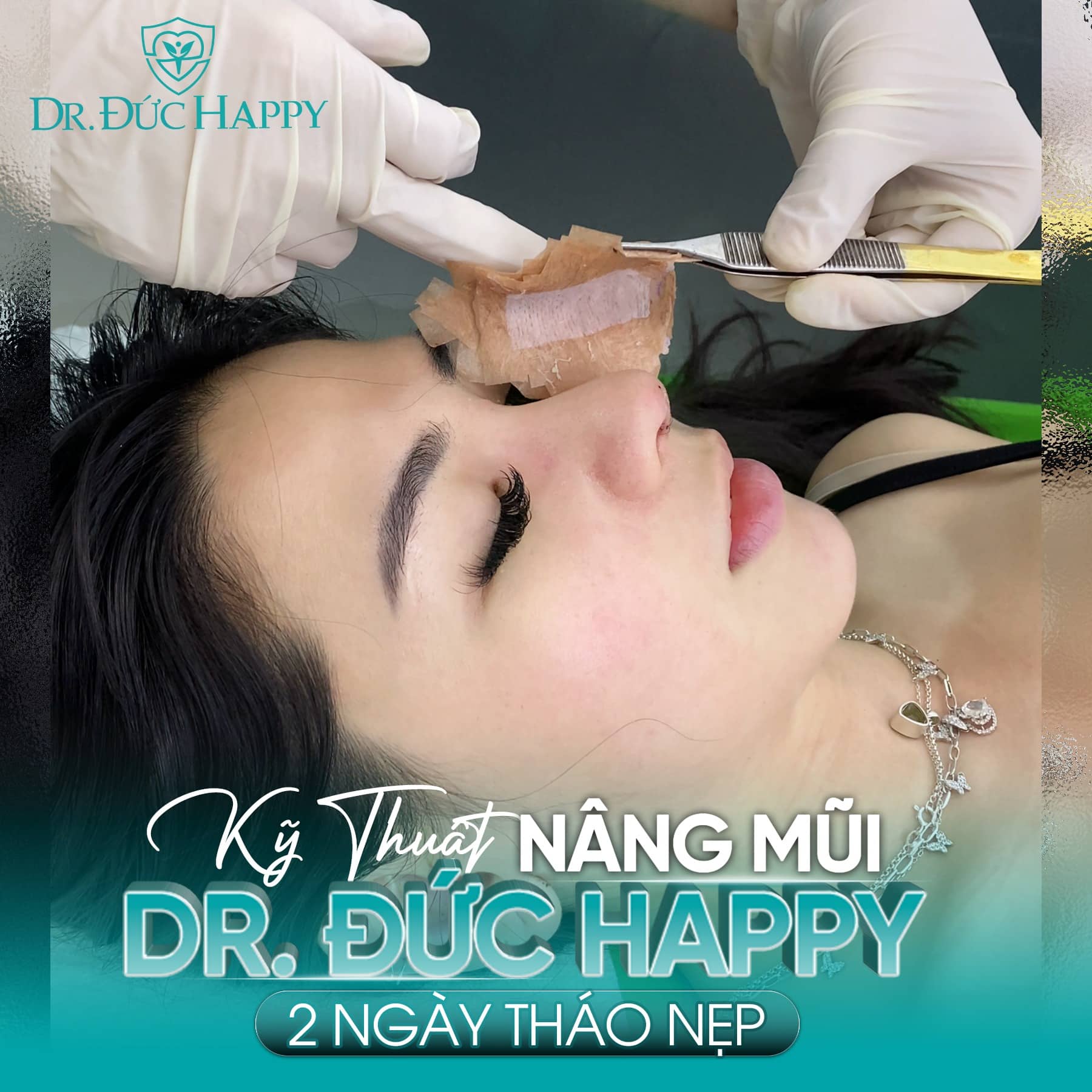 Kỹ thuật nâng mũi vi phẫu - 2 Ngày tháo nẹp