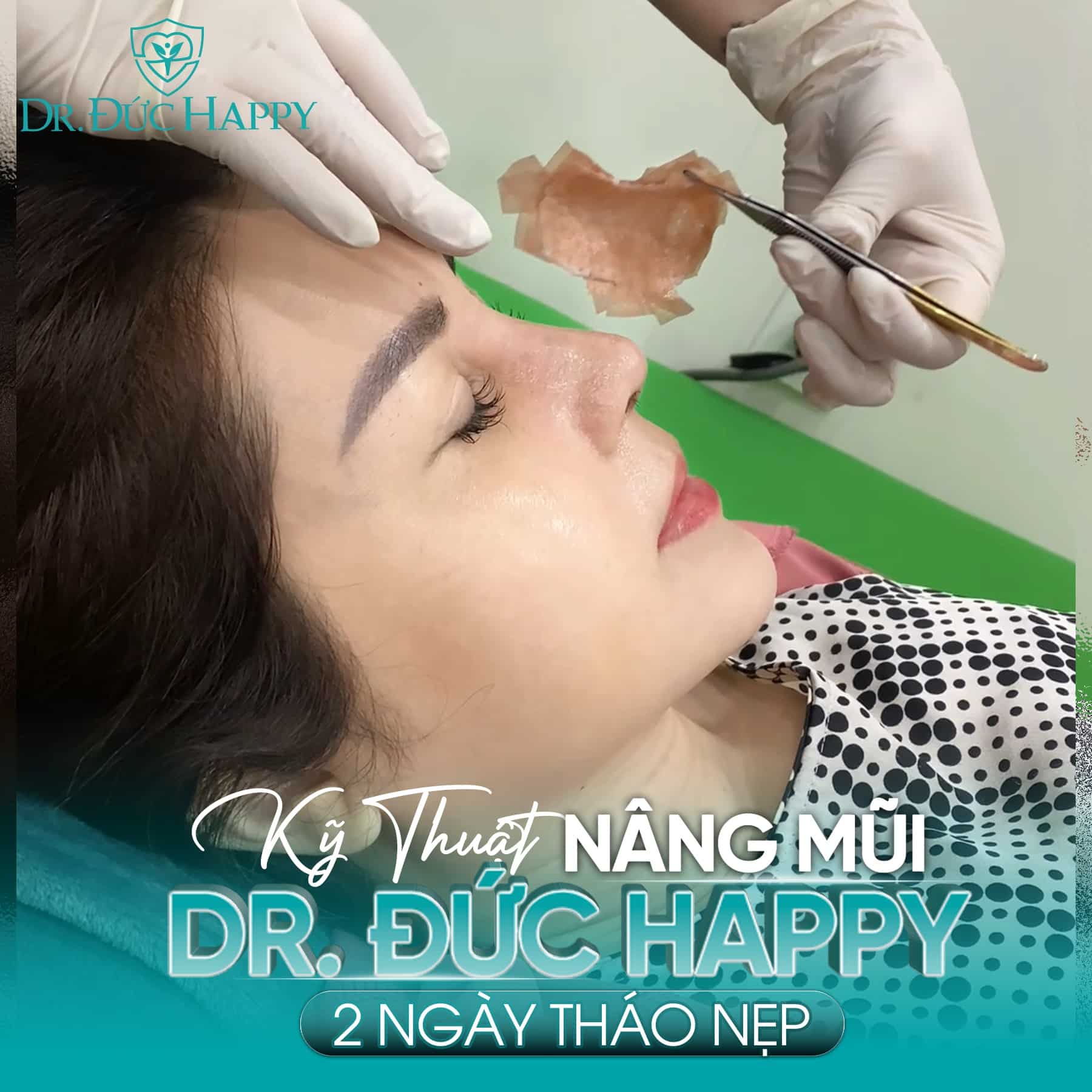 Kỹ thuật nâng mũi vi phẫu - 2 Ngày tháo nẹp