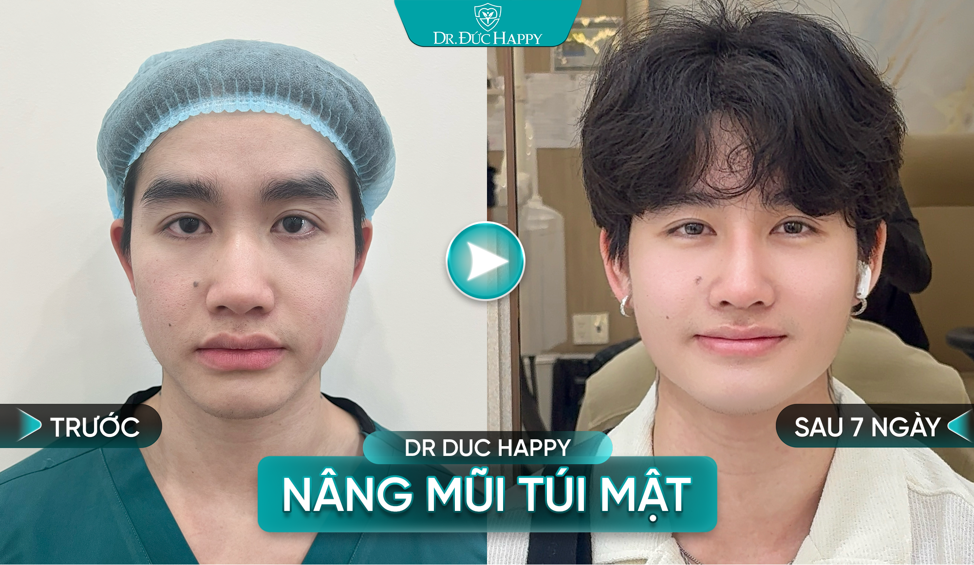 khách nam nâng mũi túi mật sau 7 ngày 