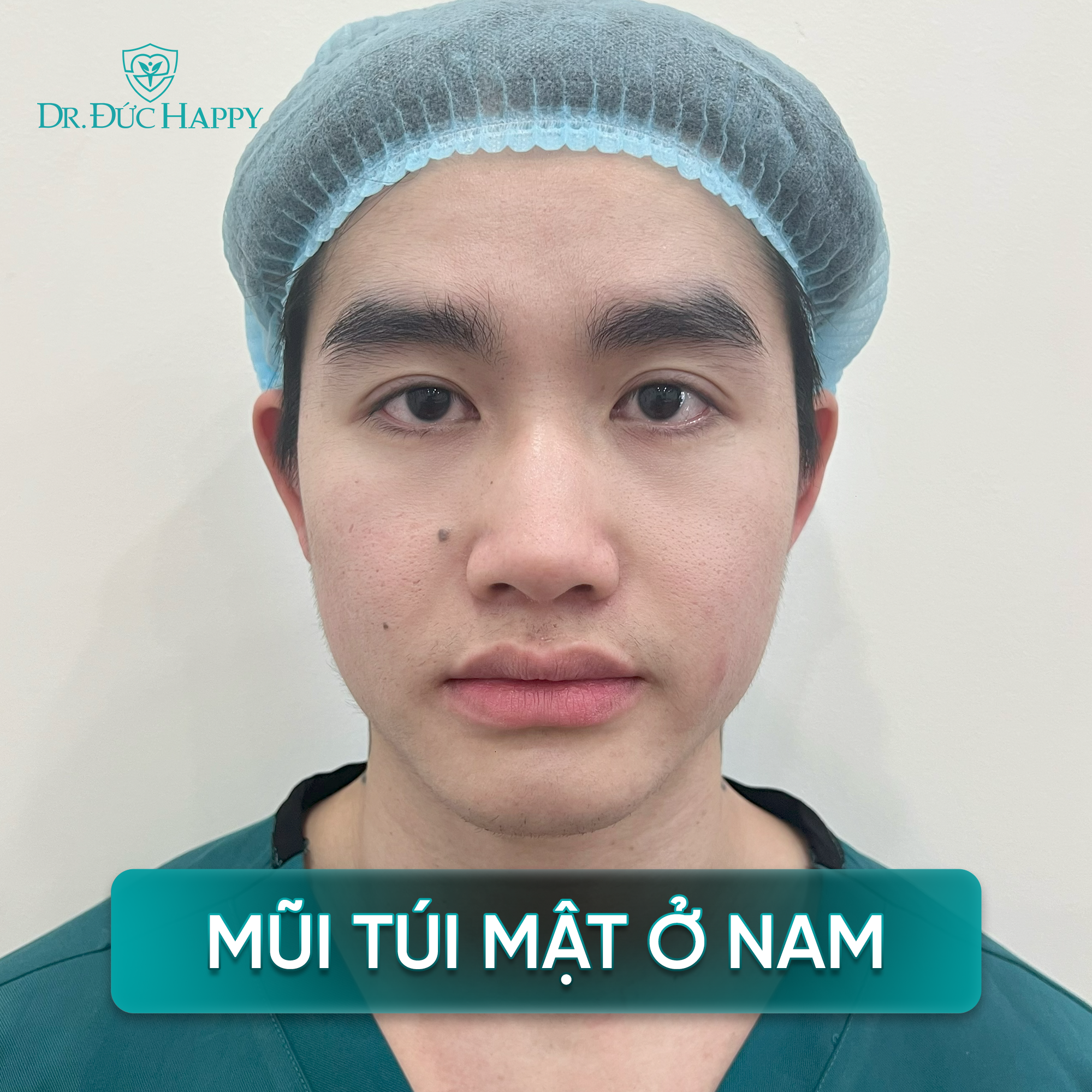 mũi túi mật ở nam