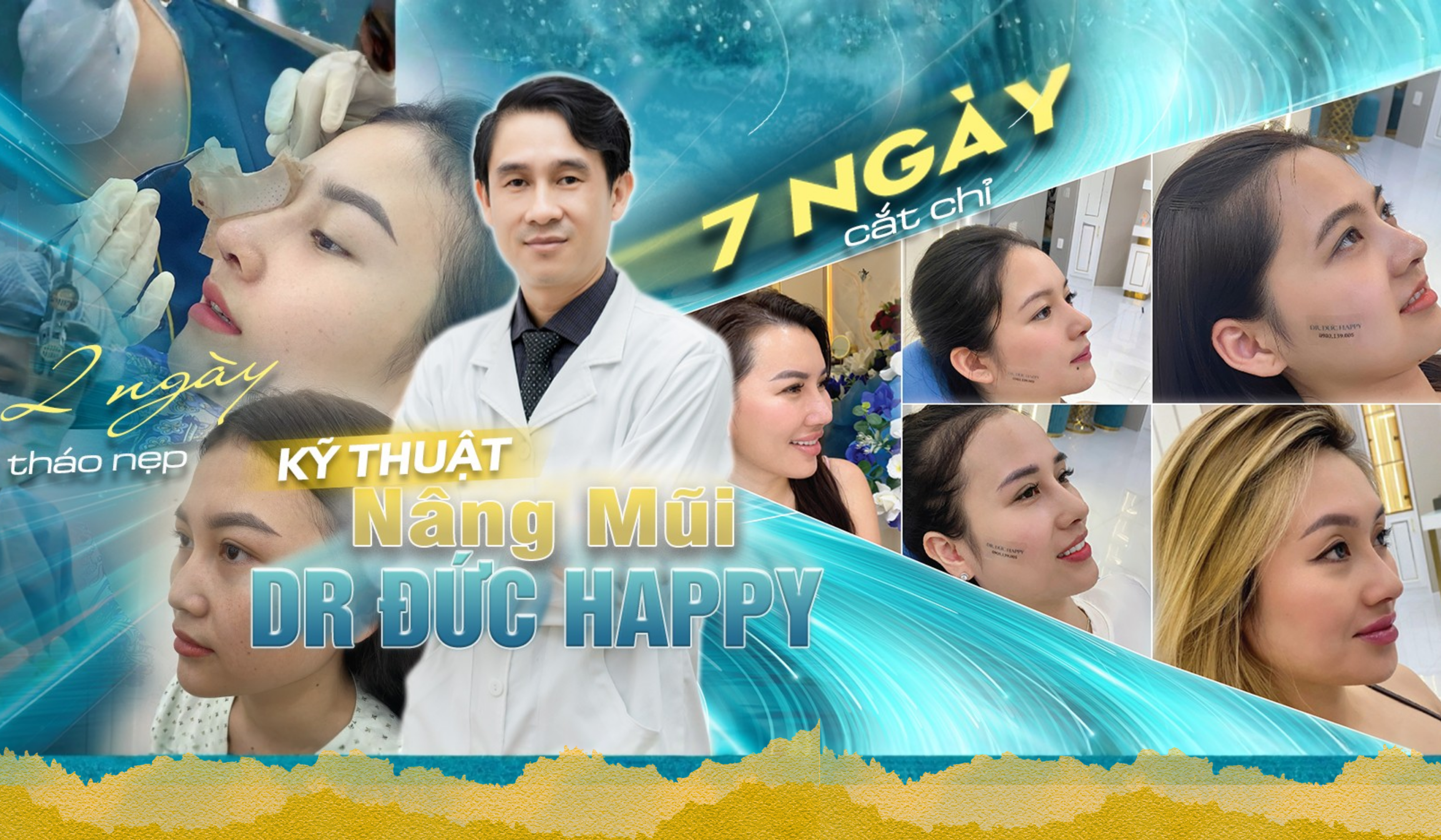 Nâng mũi ở đâu đẹp nhất Sài Gòn