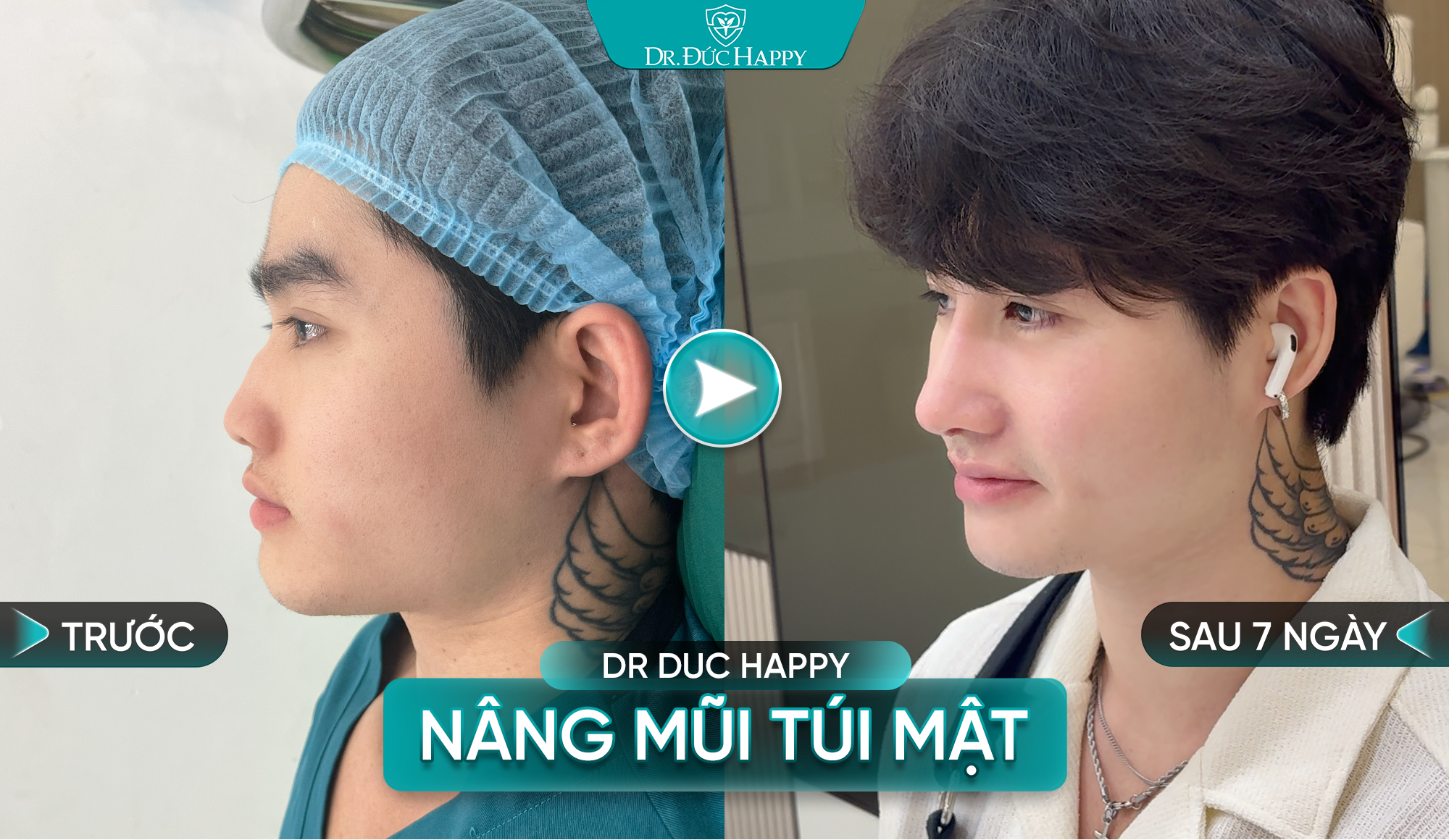 nâng mũi túi mật nam sau 7 ngày
