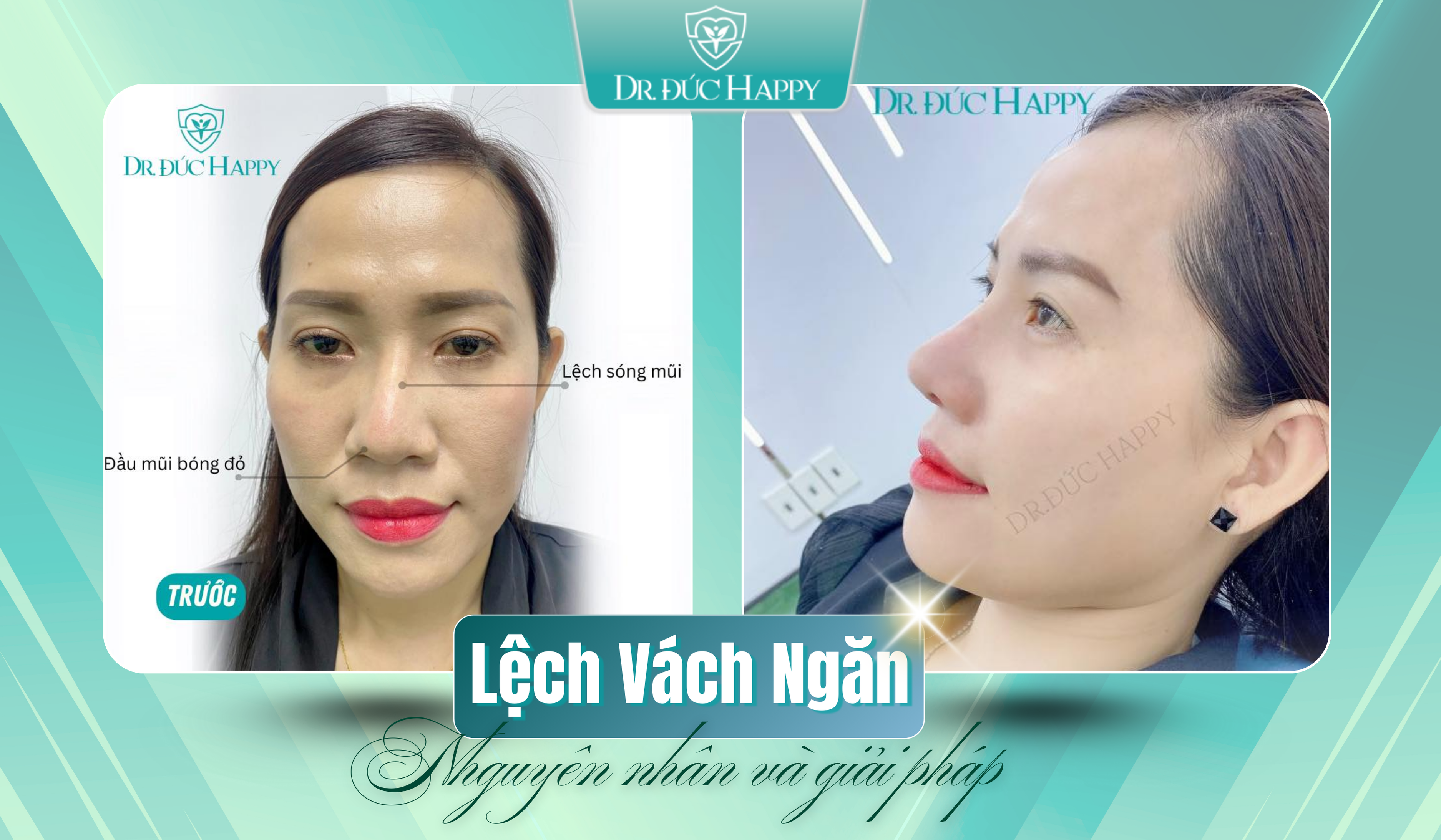 Lệch vách ngăn mũi