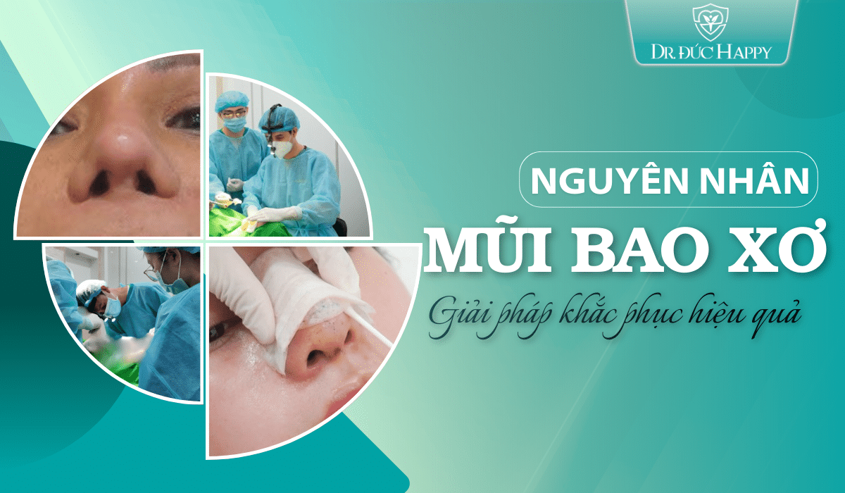 nguyên nhân mũi bị bao xơ