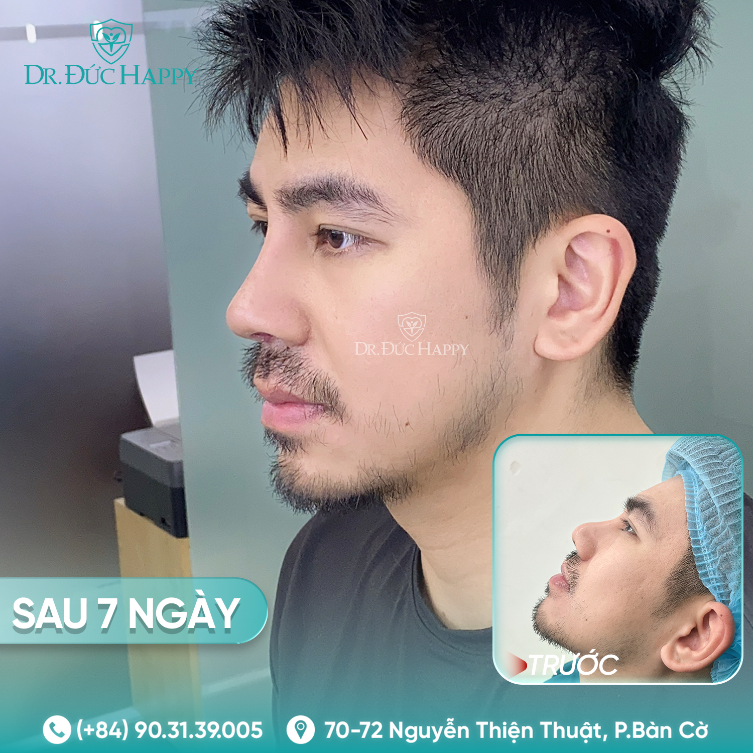 Anh Tuấn - Khách hàng nam nâng mũi tại Dr Duc Happy