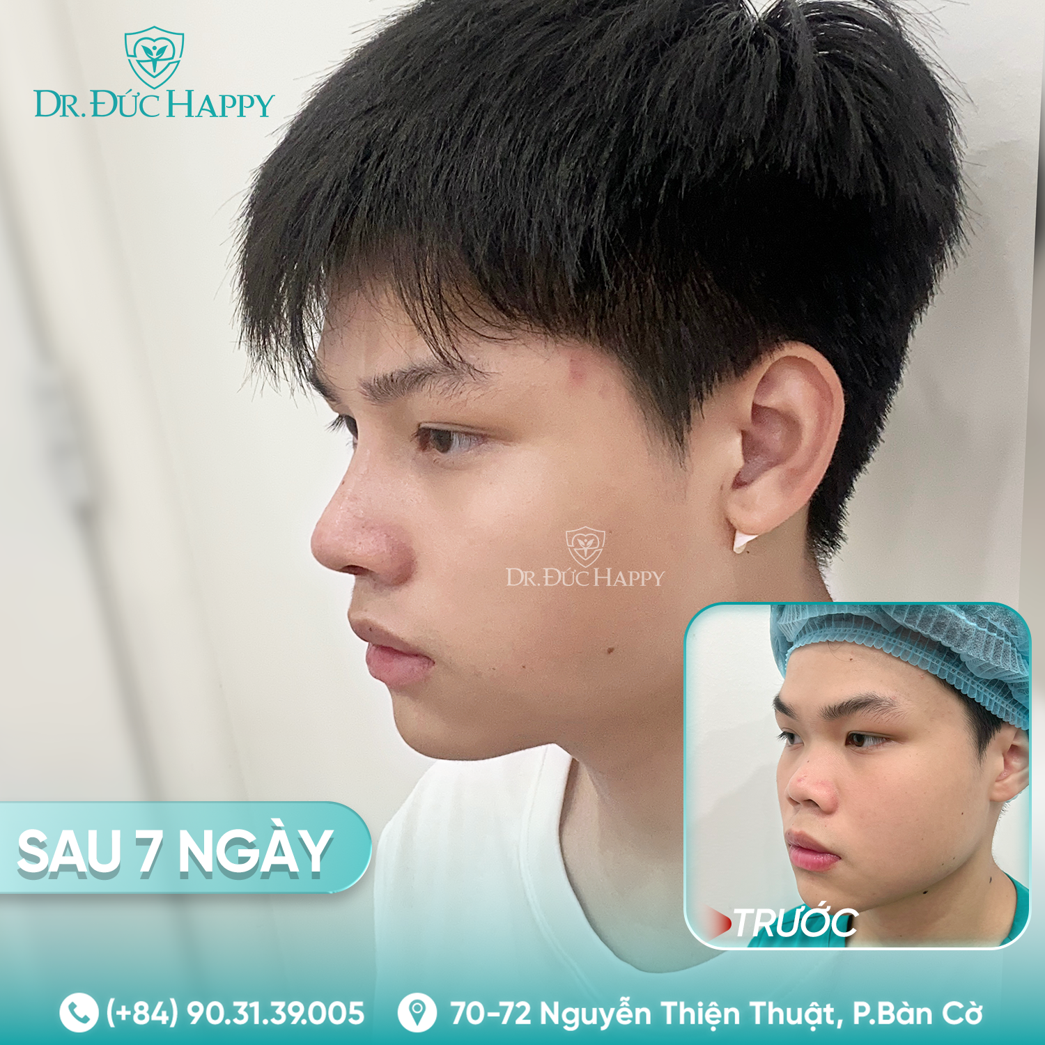 Gia Bảo - Khách hàng nam nâng mũi tại Dr Duc Happy