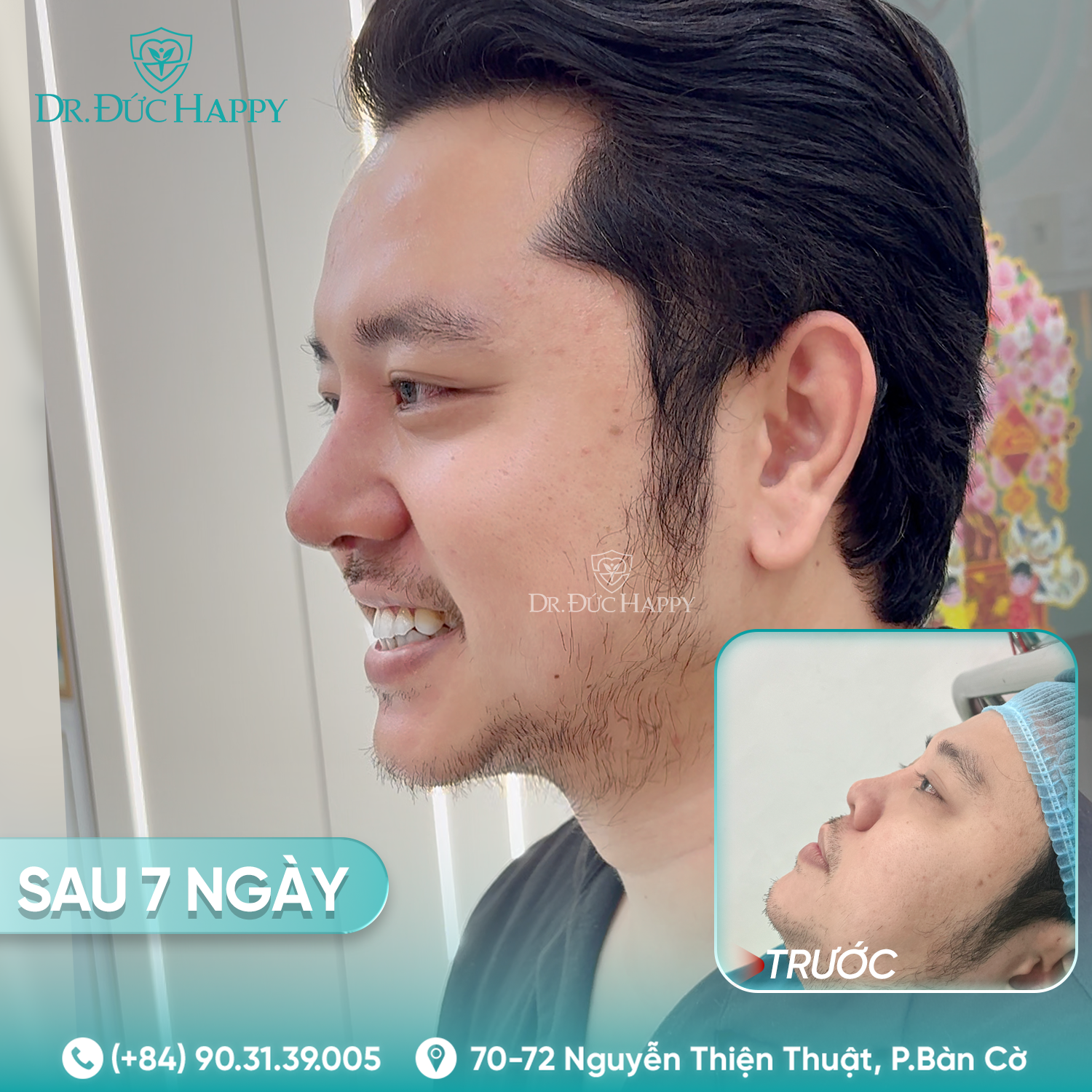 Hoàng Việt - Khách hàng nam nâng mũi tại Dr Duc Happy