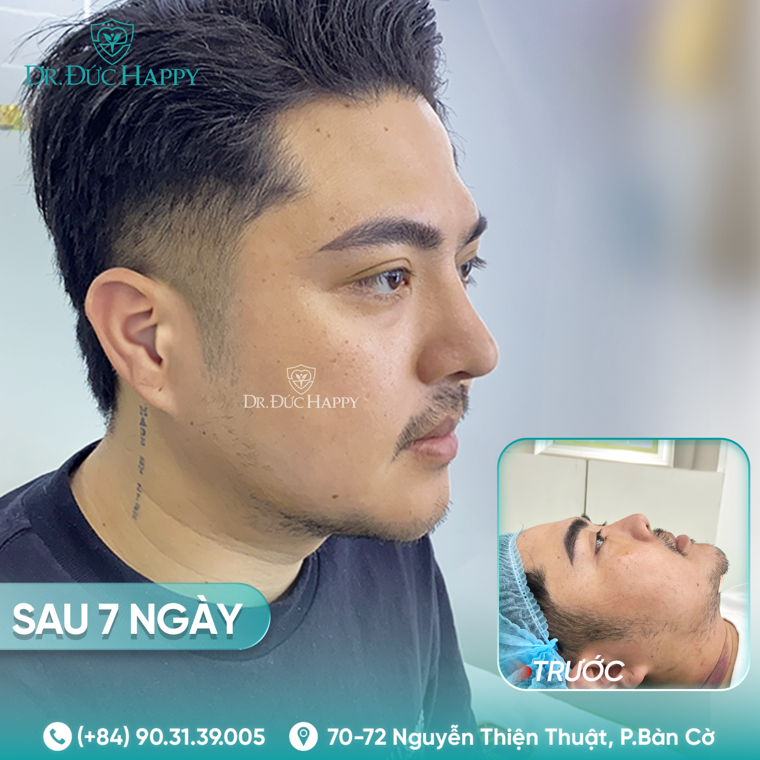 Khoa Dominic - Khách hàng nam nâng mũi tại Dr Duc Happy