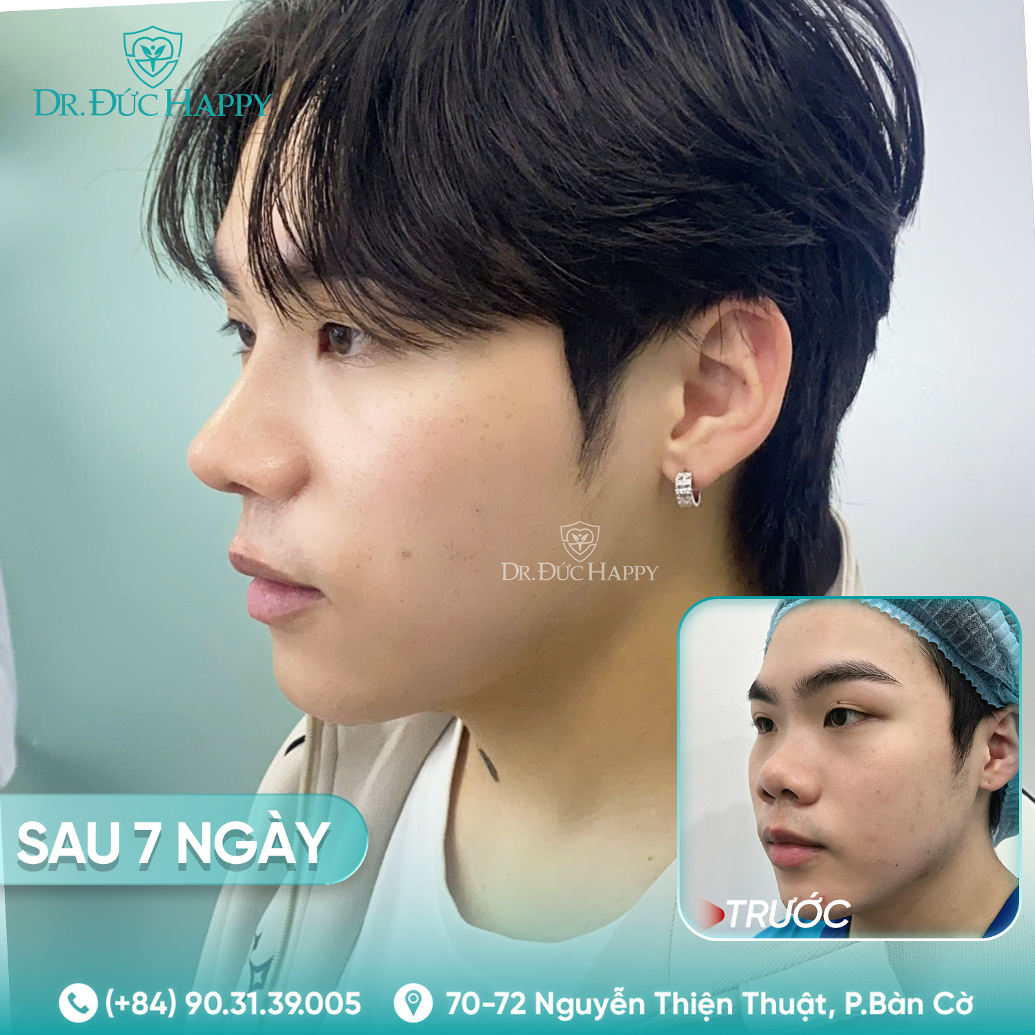 Nguyễn Christopher - Khách hàng nam nâng mũi tại Dr Duc Happy