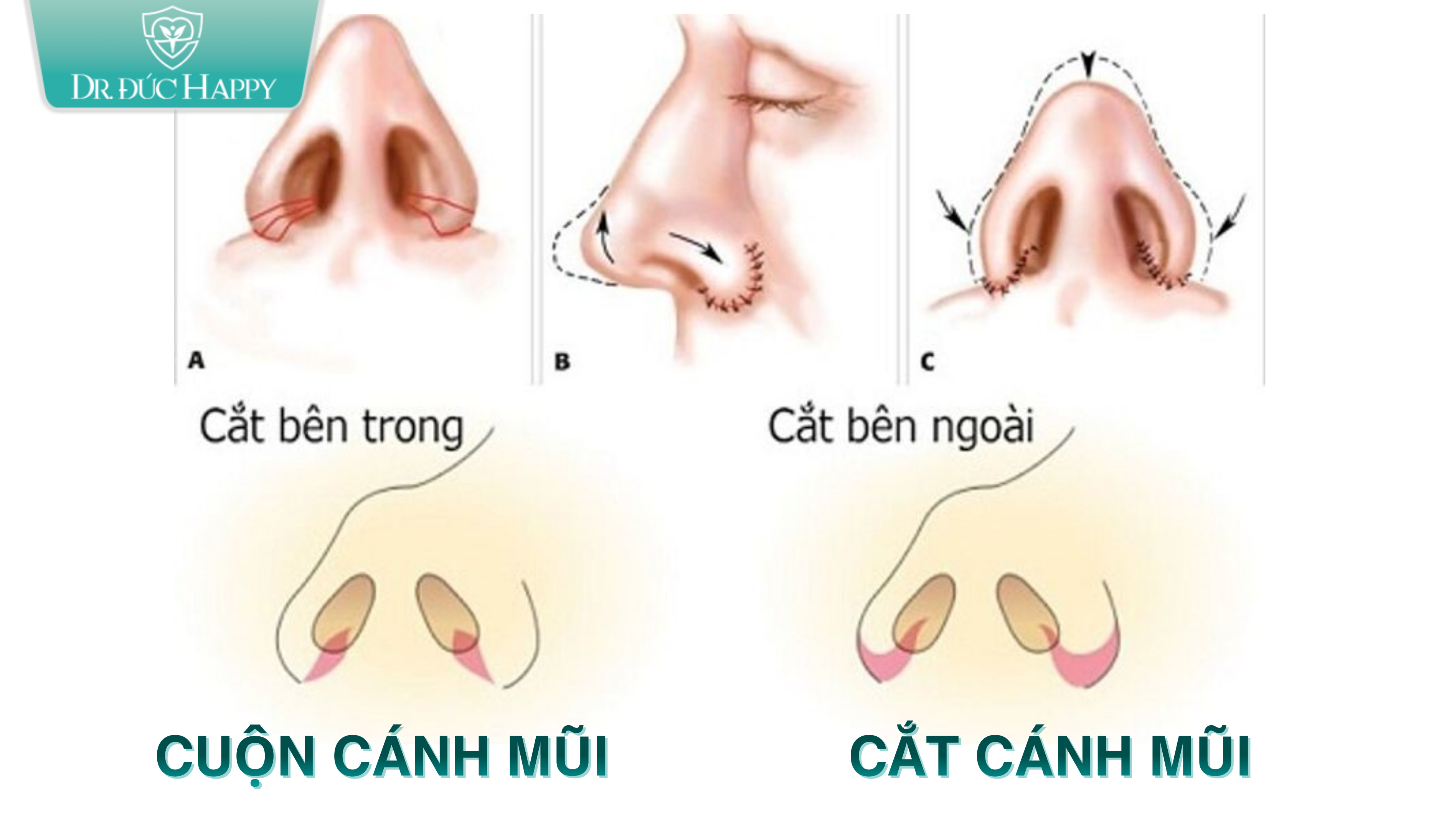 Phân biệt cắt cánh mũi và cuộn cánh mũi