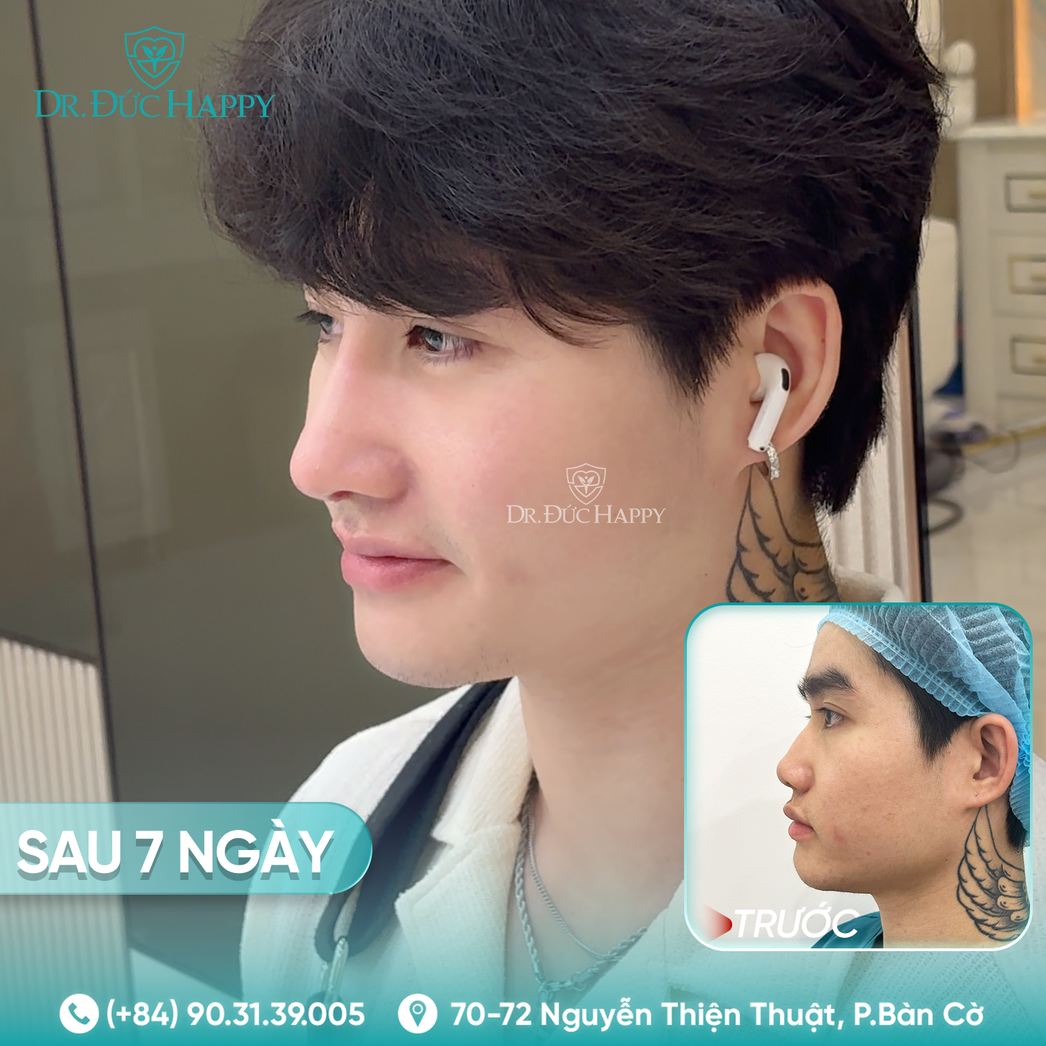 Thiên Phước - Khách hàng nam nâng mũi tại Dr Duc Happy