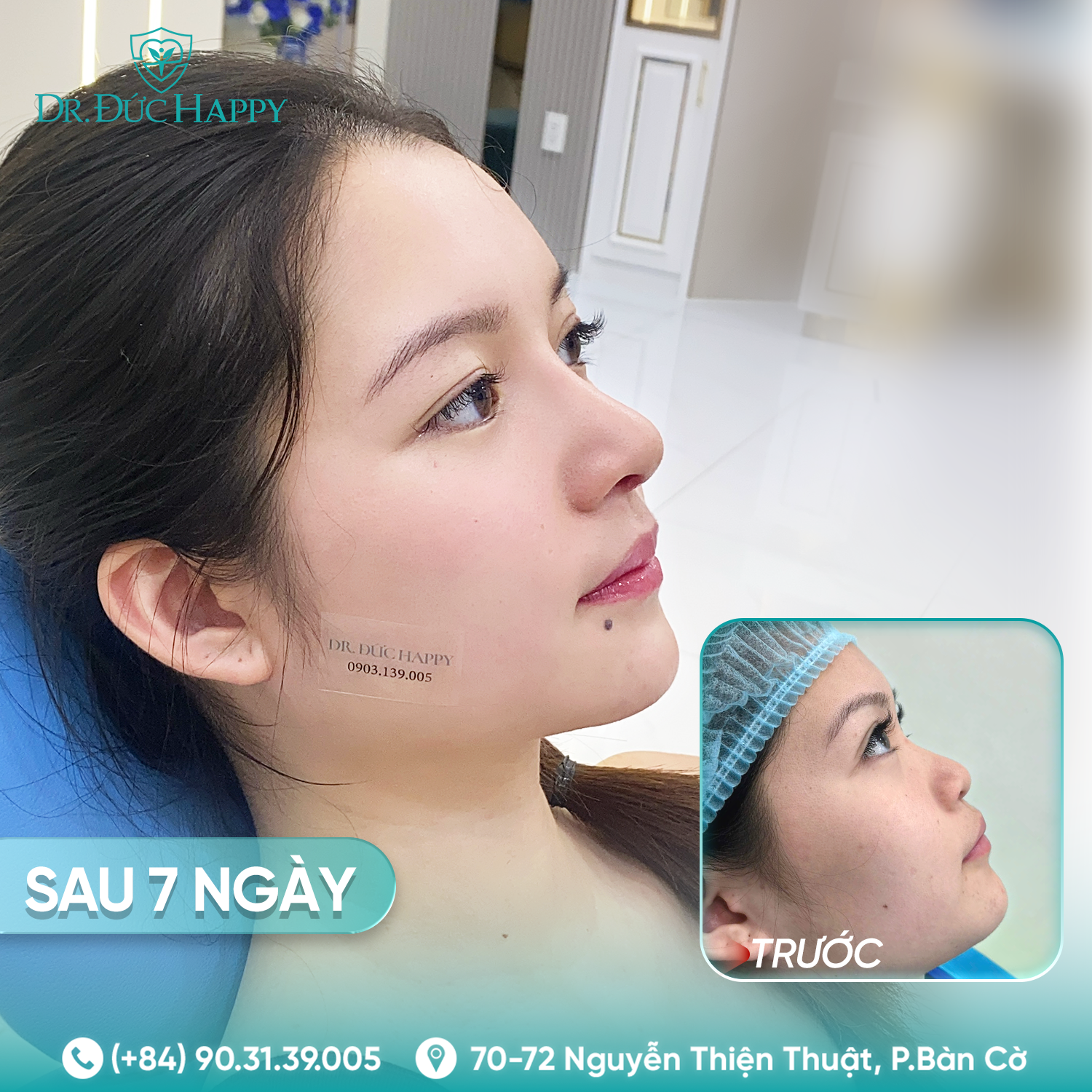 Bảo Ngân - Khách hàng nâng mũi tại Dr Duc Happy
