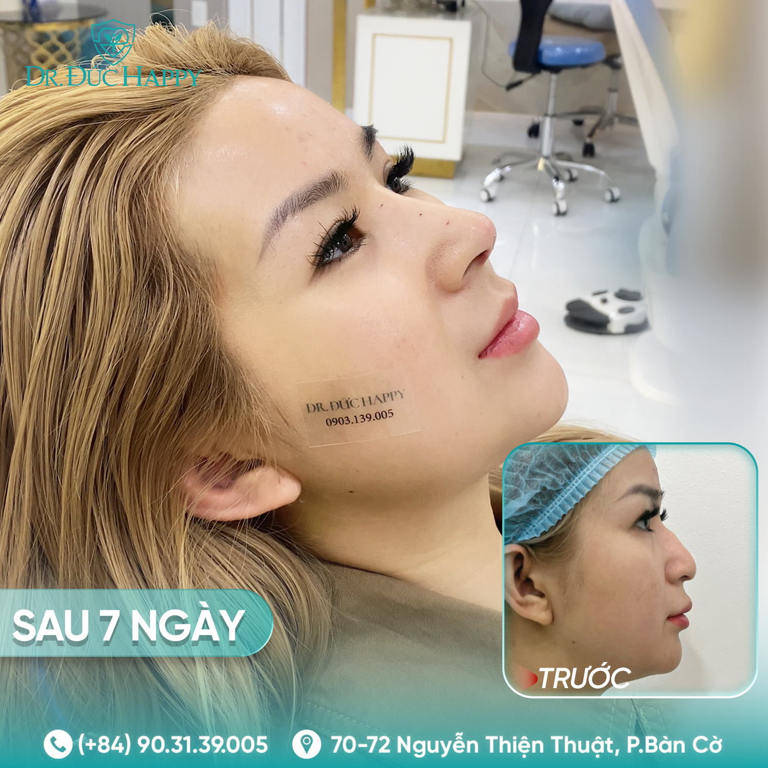 Huệ Nguyễn - Khách hàng nâng mũi tại Dr Duc Happy