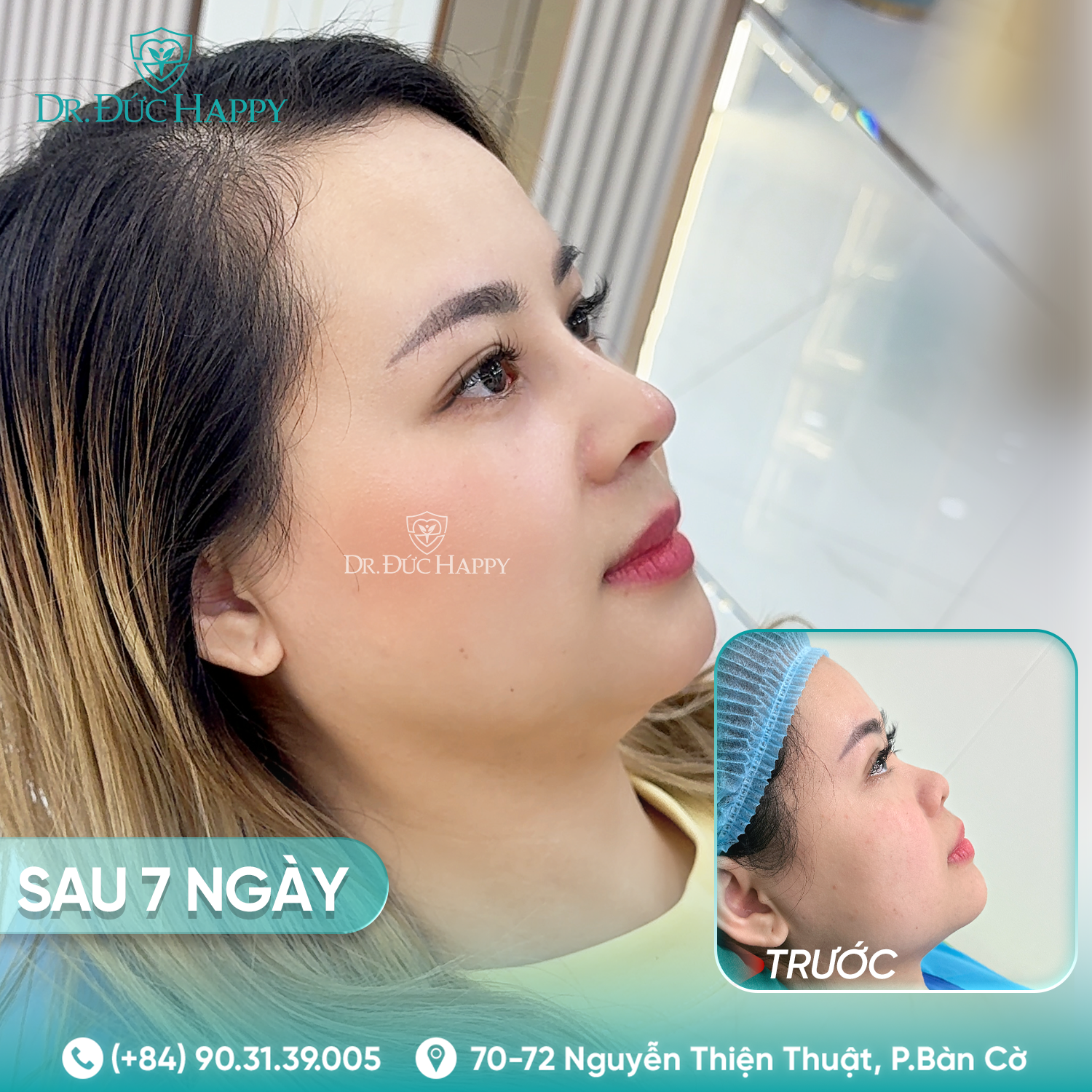 Kaylee Lâm - Khách hàng nâng mũi tại Dr Duc Happy