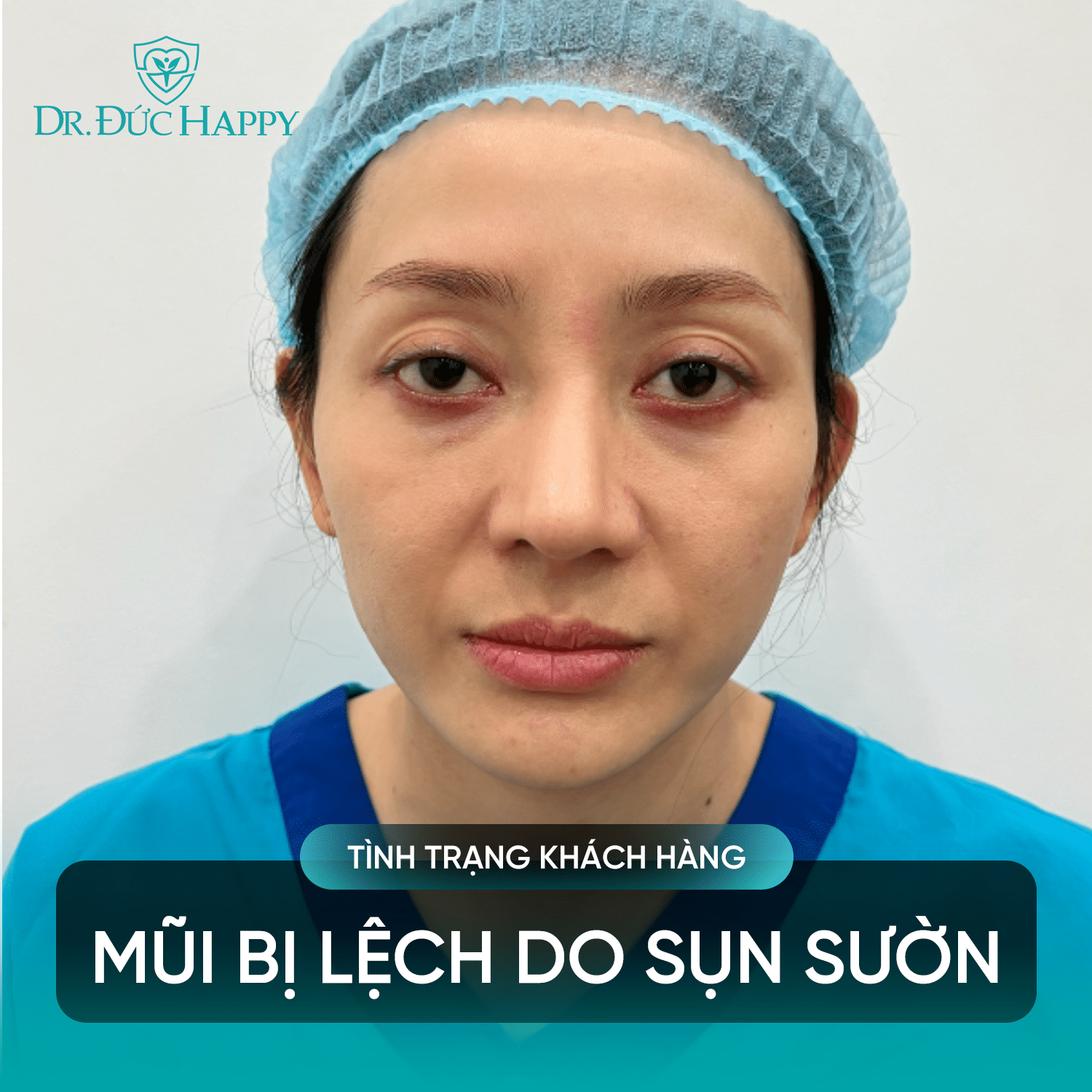 mũi bị lệch do vật liệu nâng mũi