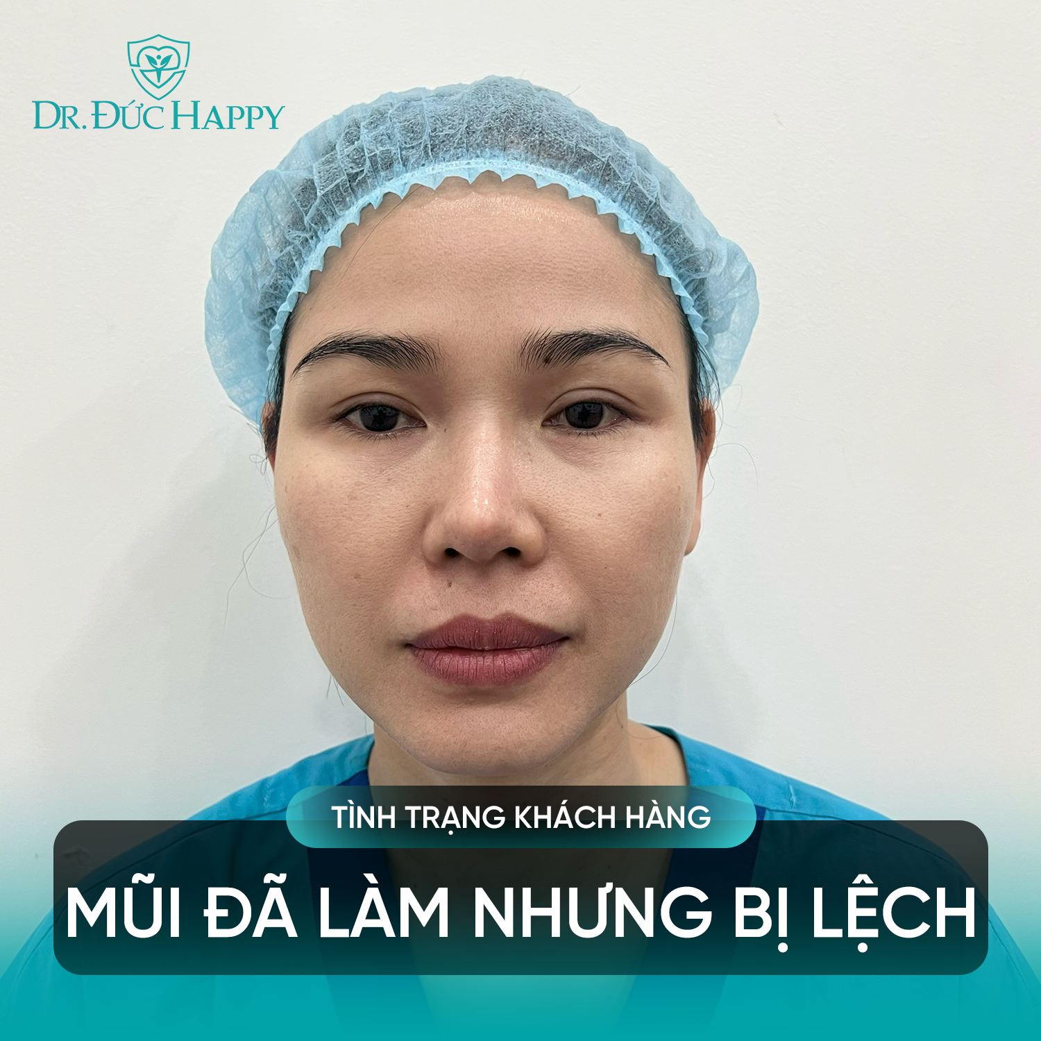mũi đã làm nhưng bị lệch do kỹ thuật mổ