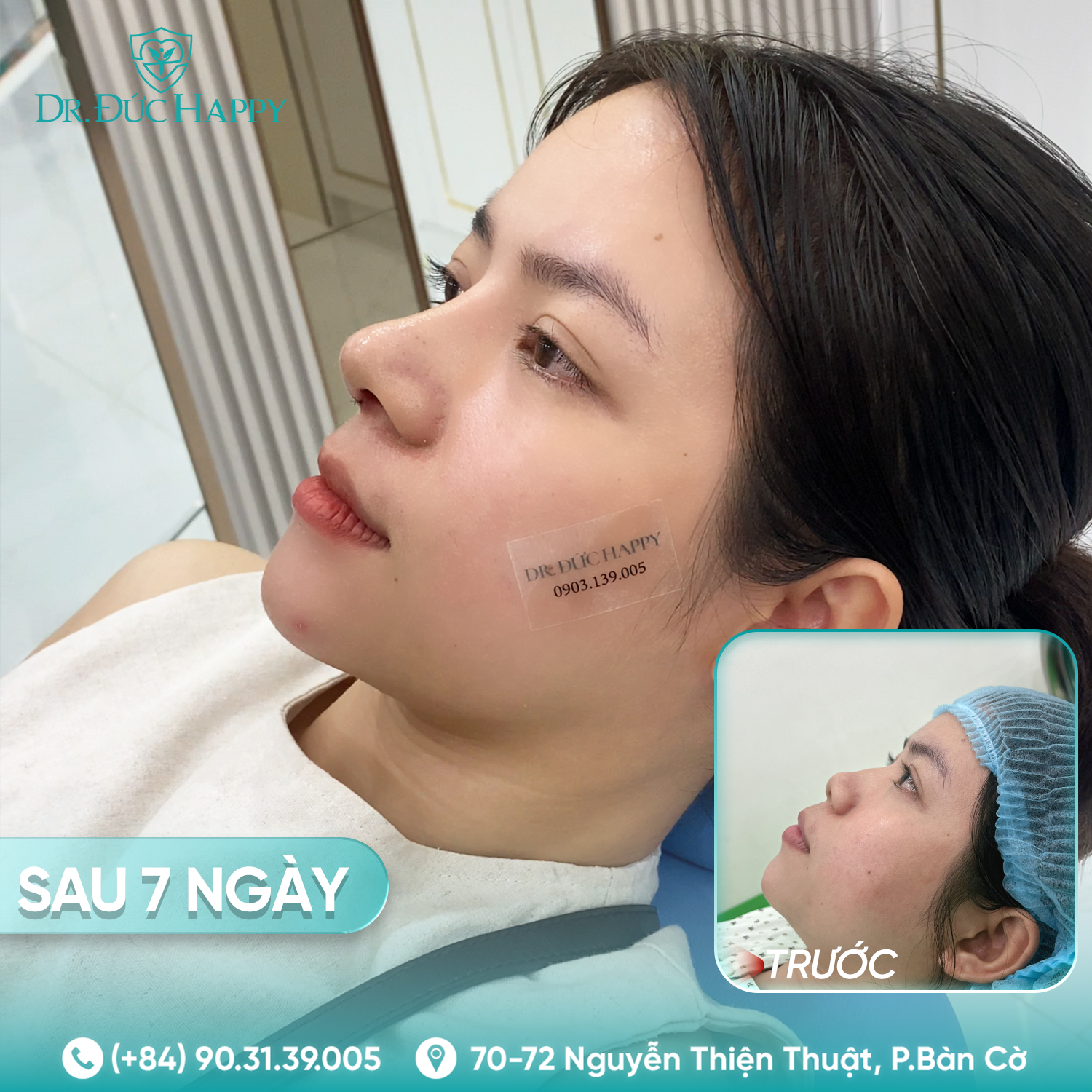 Đông Nguyễn - khách hàng nâng mũi 2 ngày tháo nẹp tại dr duc happy