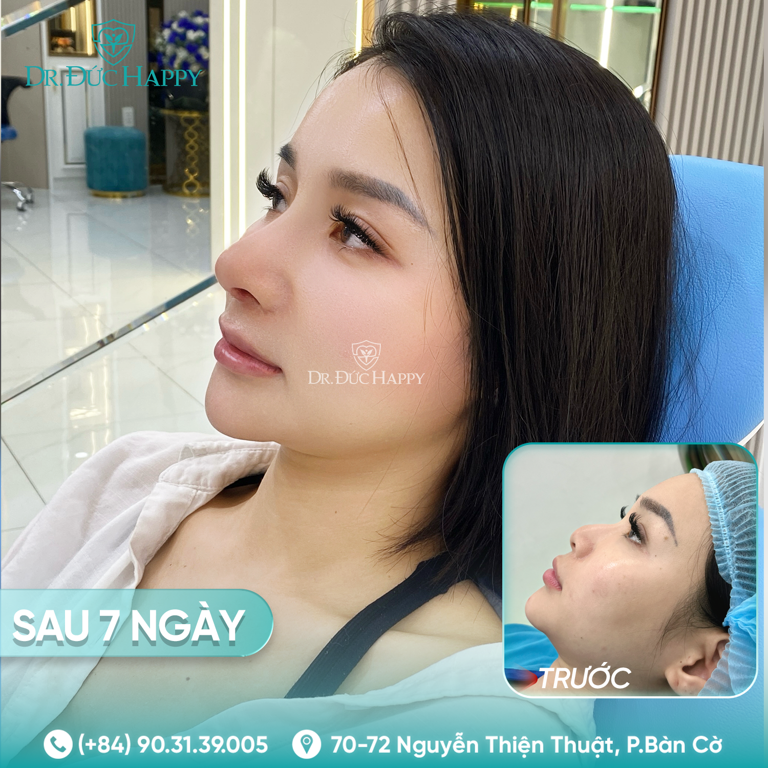 Ngọc Ánh - khách hàng nâng mũi 2 ngày tháo nẹp tại dr duc happy