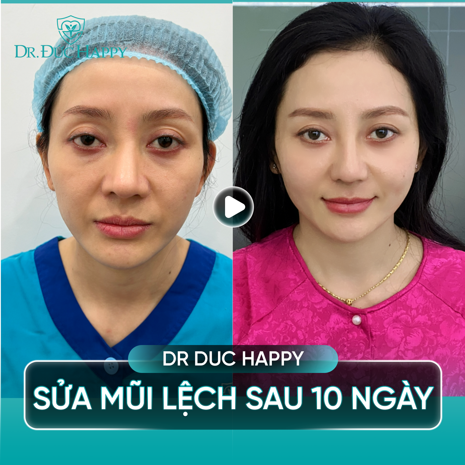 sửa mũi sụn sườn bị lệch sau 10 ngày