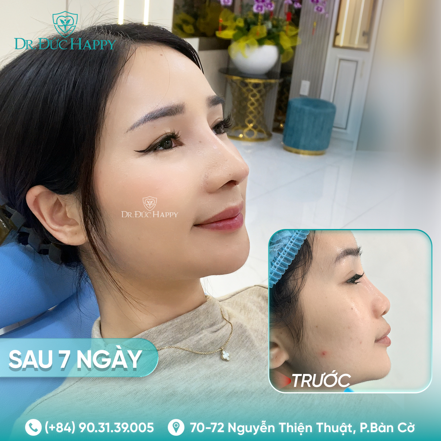 Thư Nguyễn - khách hàng nâng mũi 2 ngày tháo nẹp tại dr duc happy