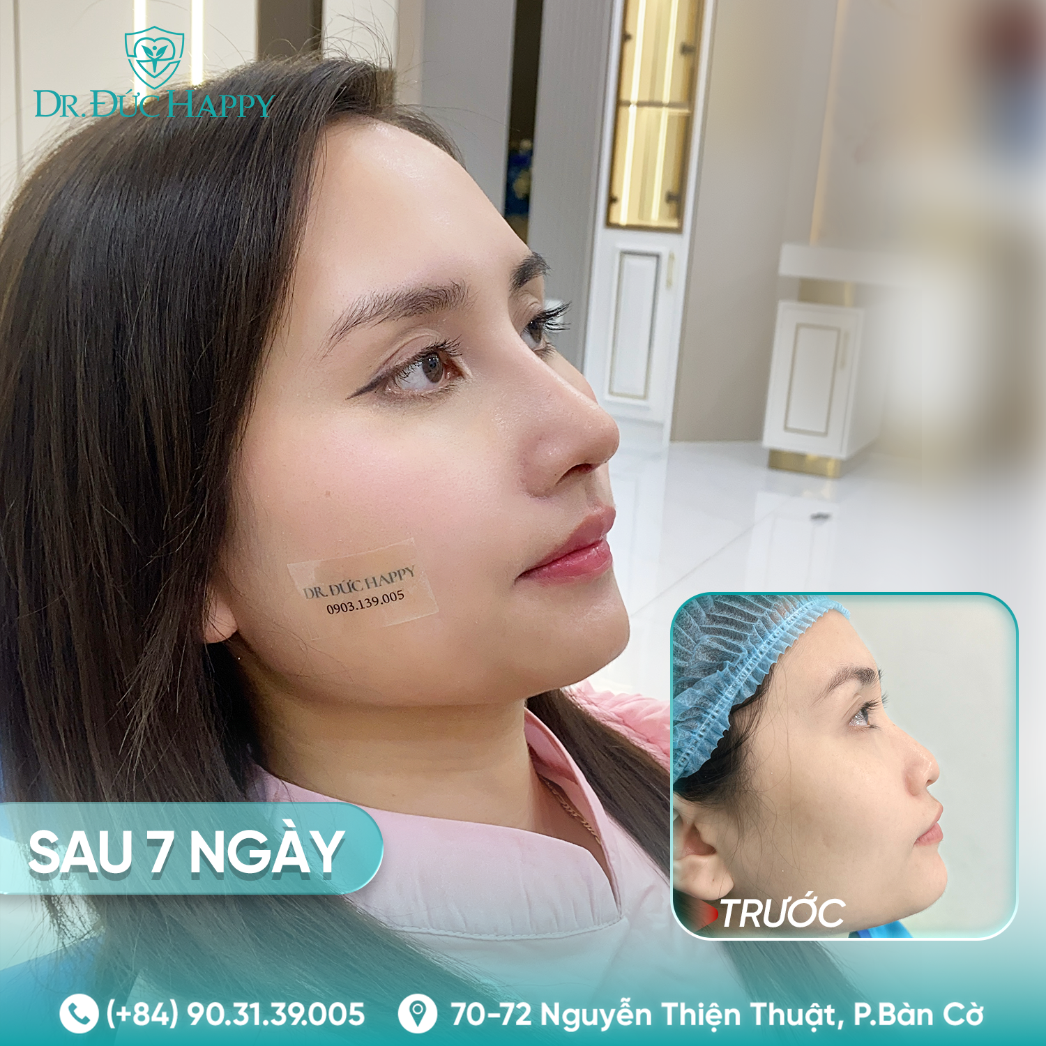 Thùy Linh - khách hàng nâng mũi 2 ngày tháo nẹp tại dr duc happy