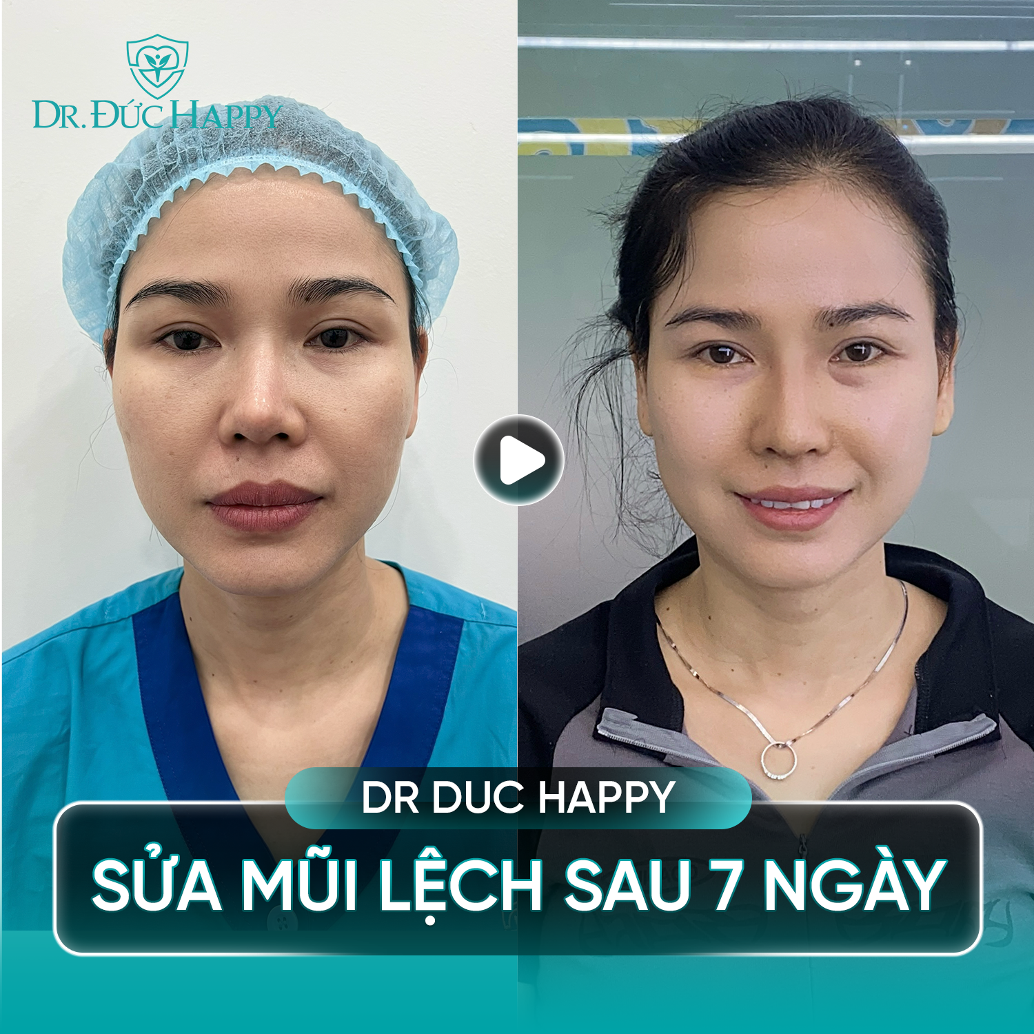 Tình trạng mũi lệch cải thiện tương đối vào ngày thứ 7