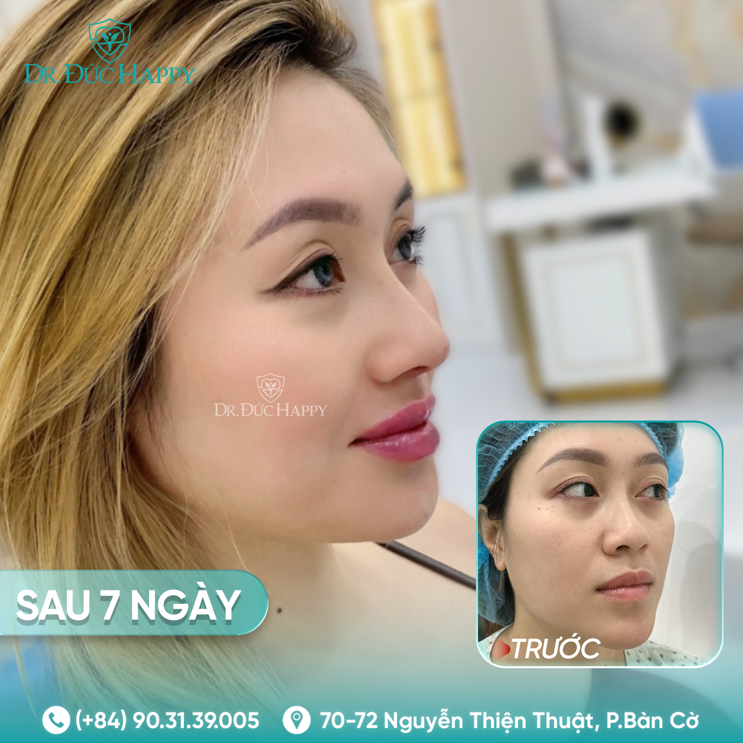 xuân anh - khách hàng nâng mũi 2 ngày tháo nẹp tại dr duc happy