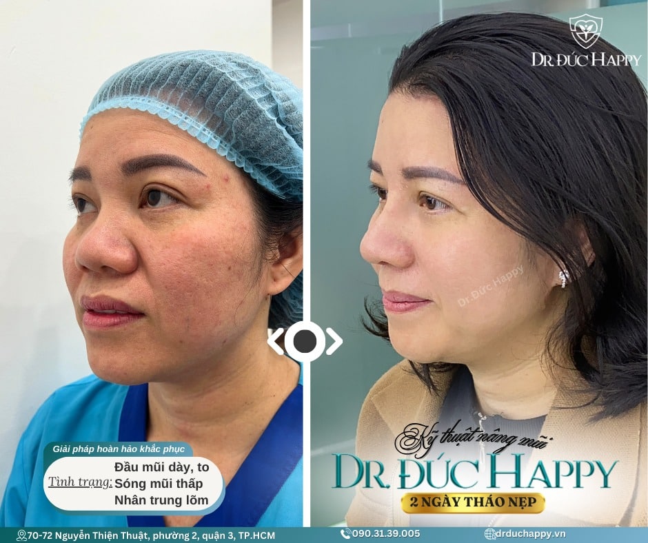 Kỹ thuật nâng mũi Dr. Đức Happy - 2 ngày tháo nẹp - sửa mũi to