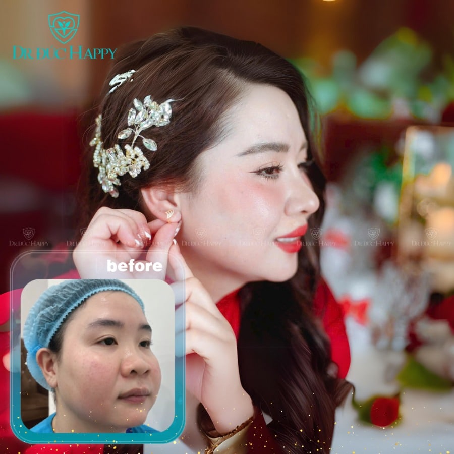 Sửa mũi to tại Dr. Đức Happy