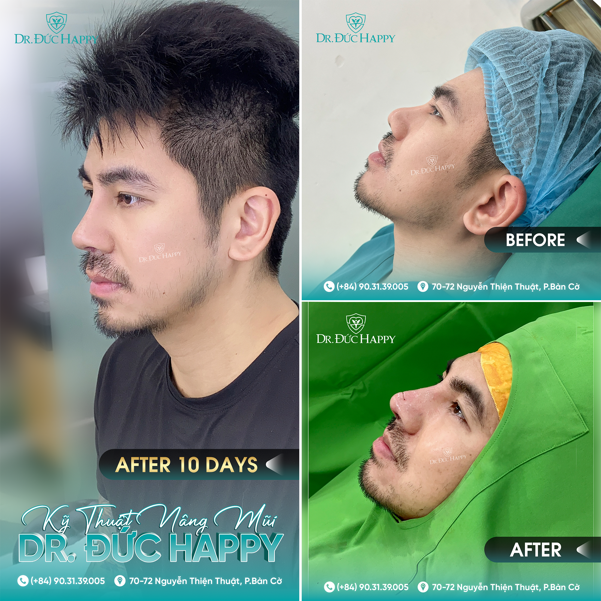 khách hàng nam giới sửa mũi lân tại dr duc happy