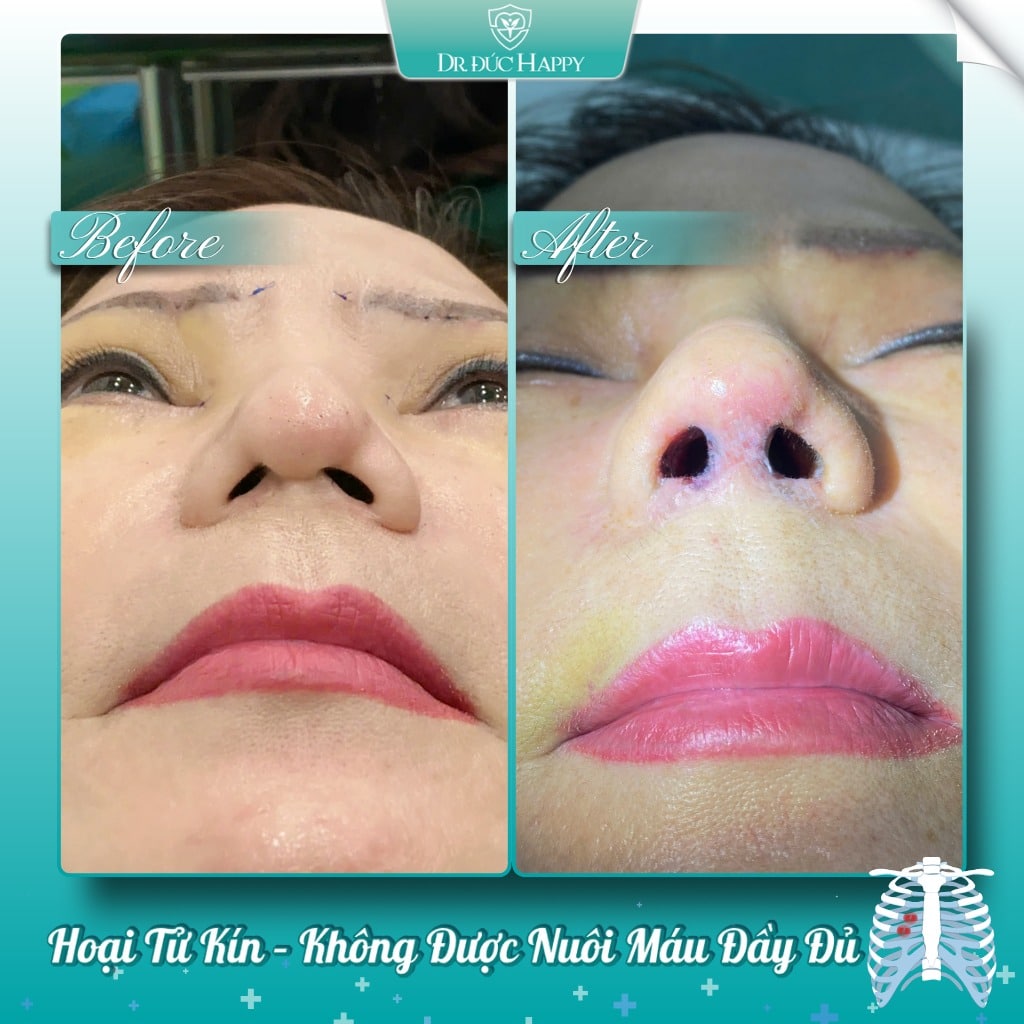 Biến chứng thường gặp của nâng mũi sụn sườn