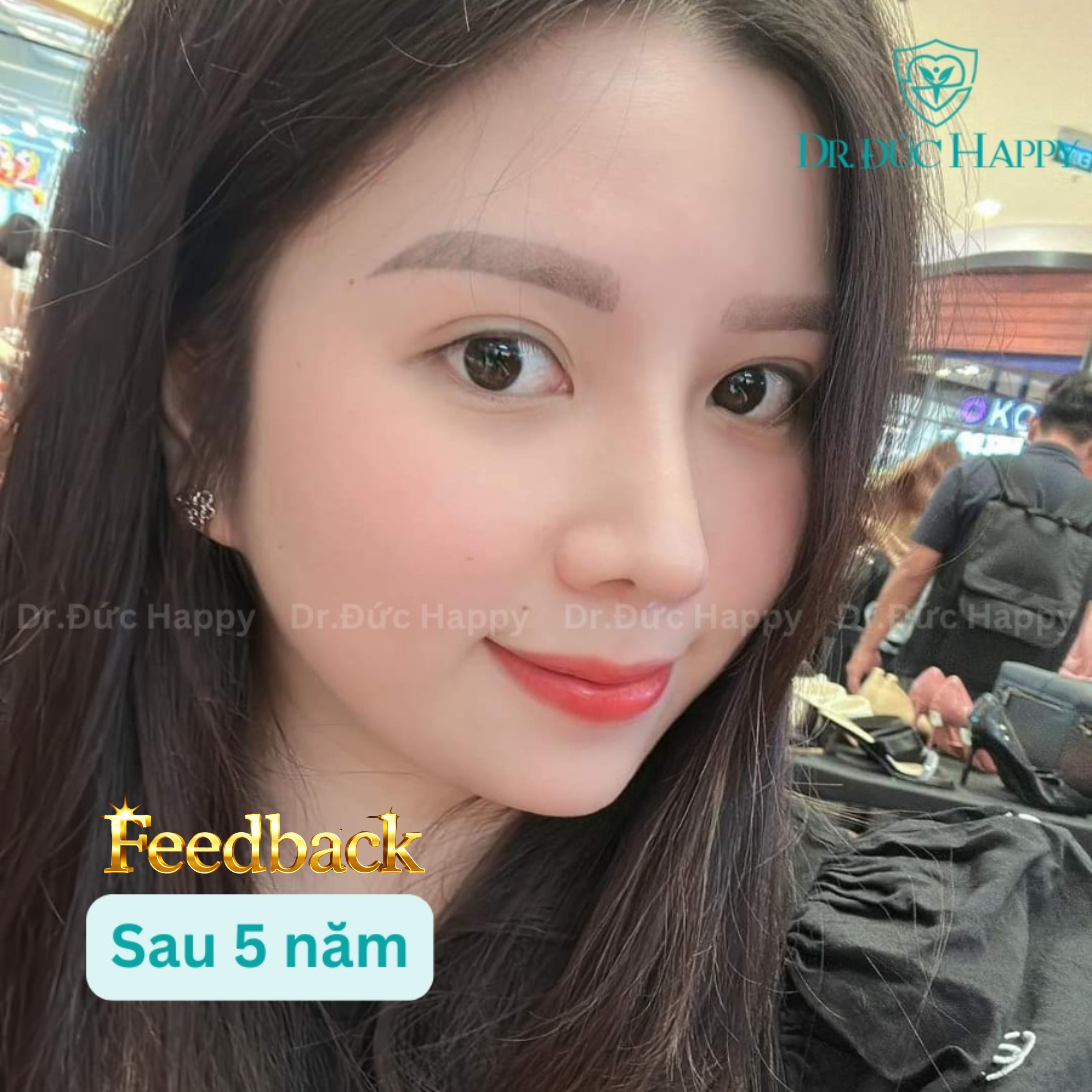 Nâng mũi lâu năm liệu dáng mũi còn đẹp?