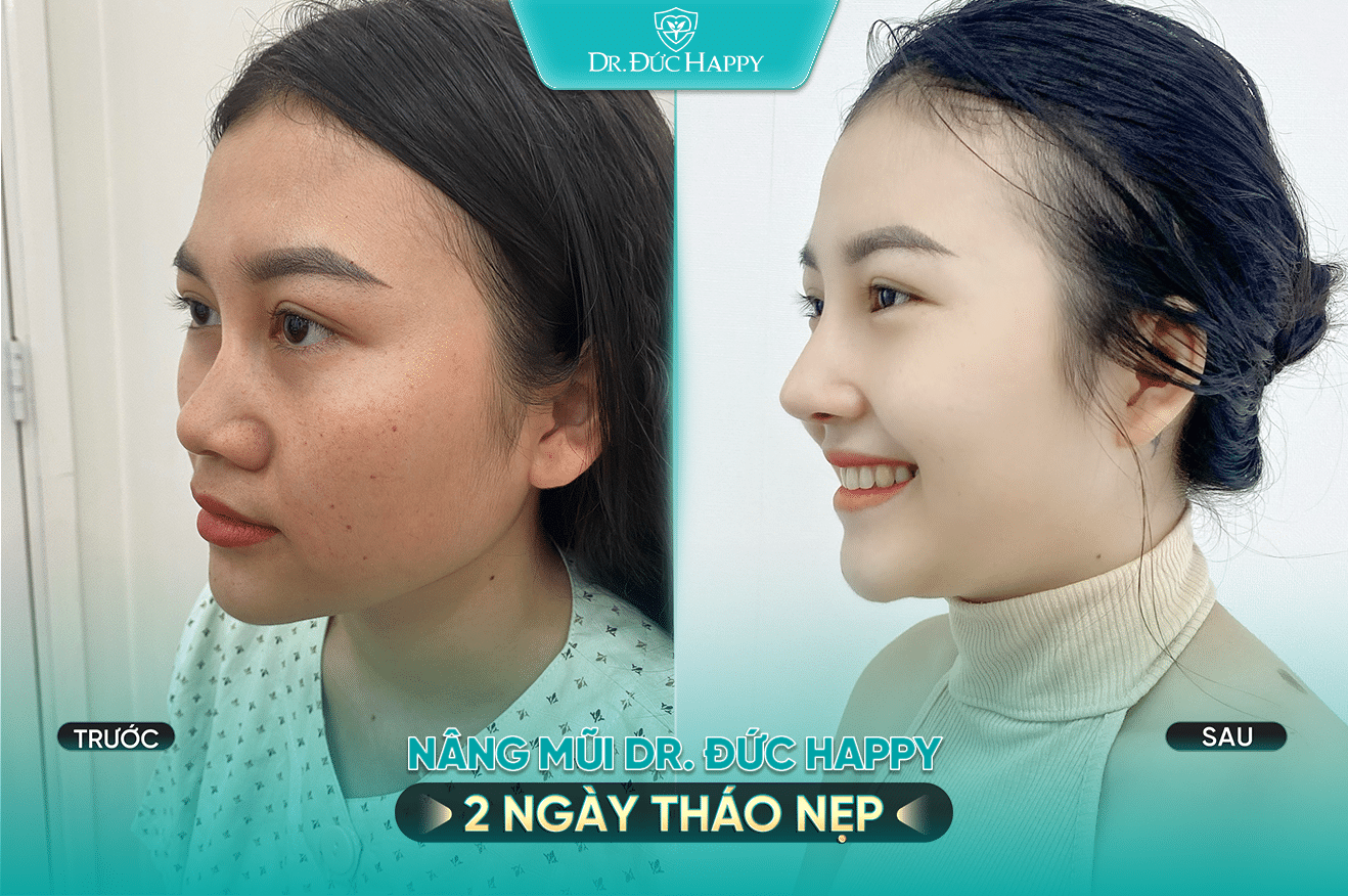 bác sĩ sửa mũi uy tín