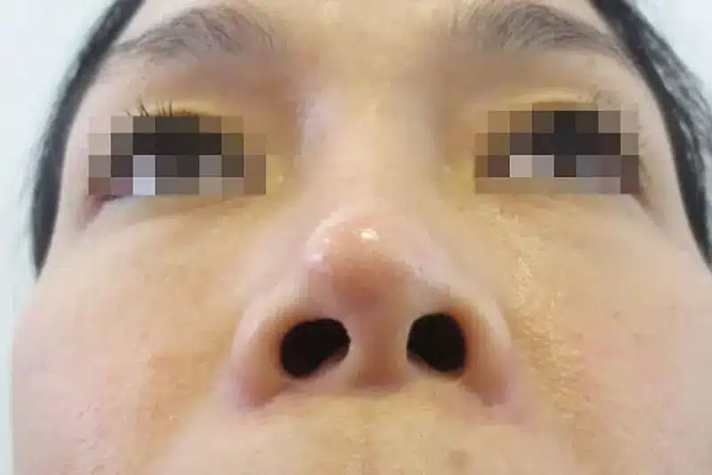 Mũi sụn sườn bị lộ sụn