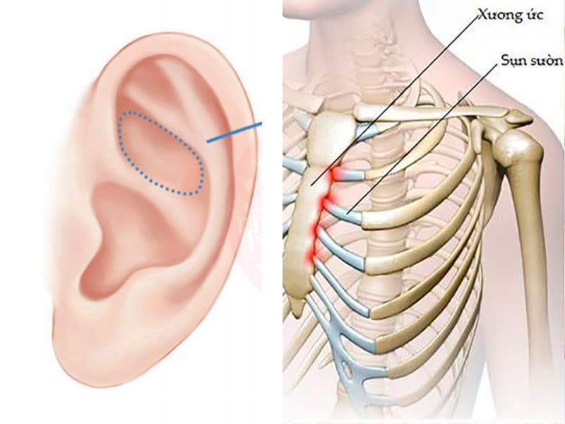 Vì sao sụn sườn tự thân vẫn có thể bị lộ