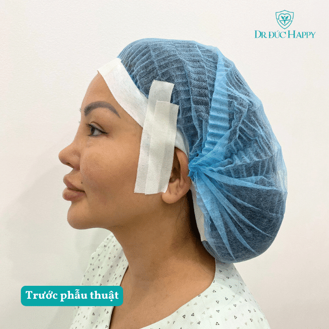 Tình trạng mũi sụn sườn của chị Teena trước chỉnh sửa