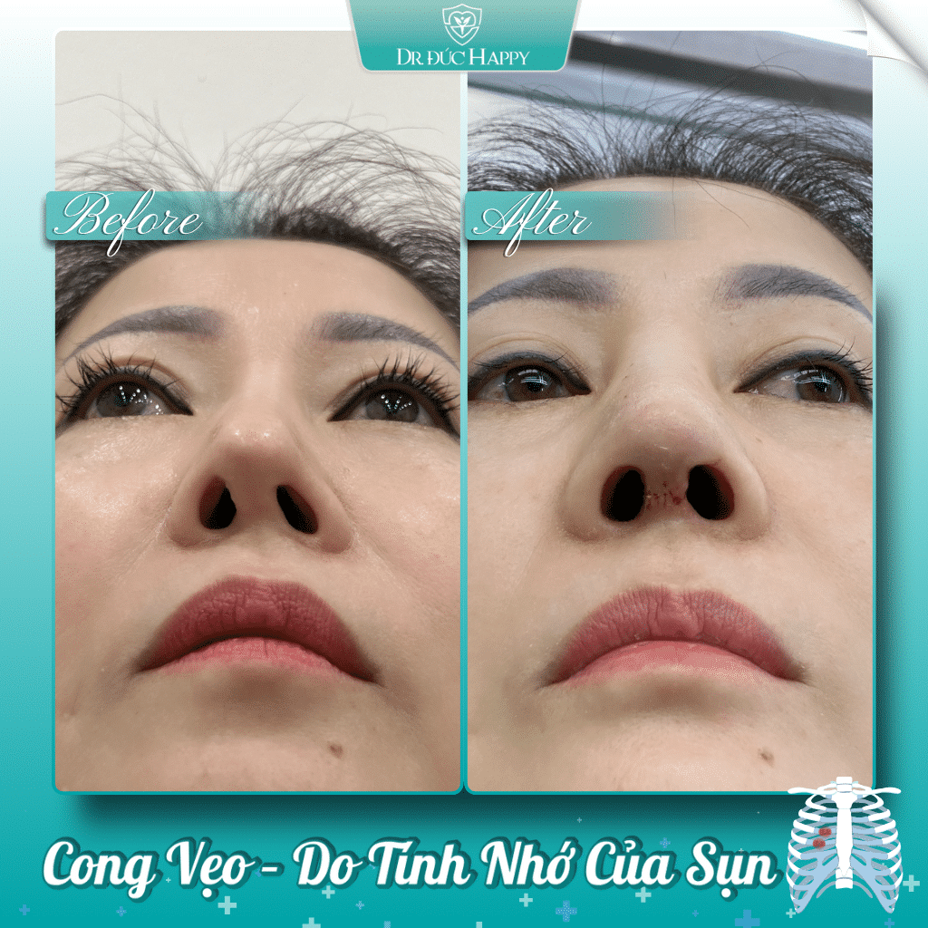 Tình trạng sụn sườn cong vênh sau nâng mũi