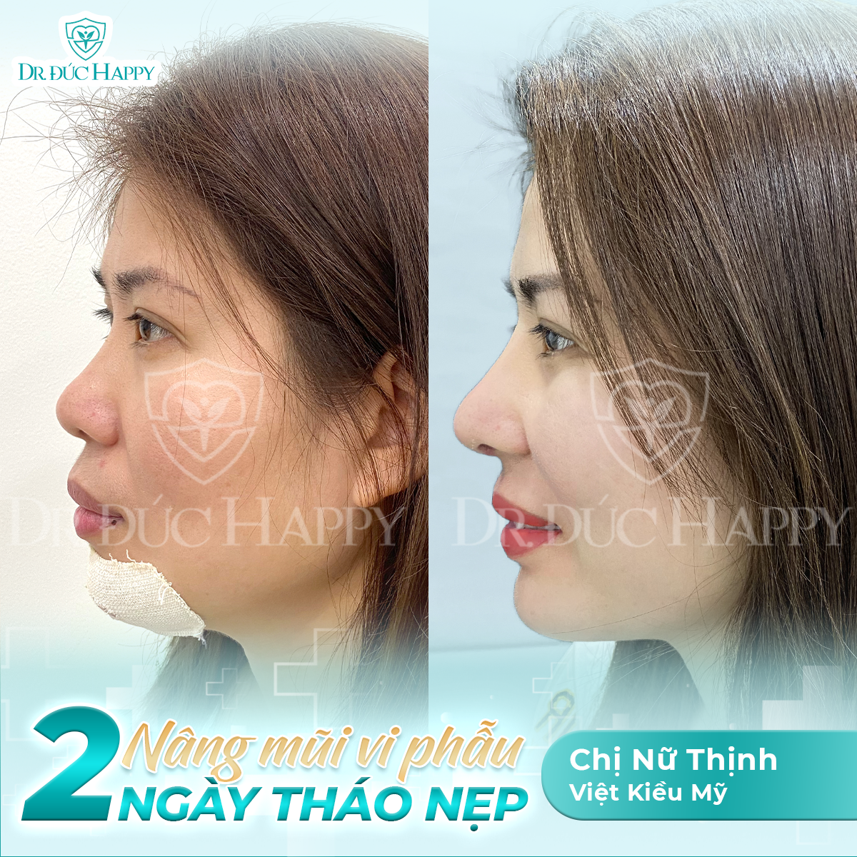 Khách Việt kiều Nữ Thịnh sau nâng sửa mũi tại Dr. Đức Happy