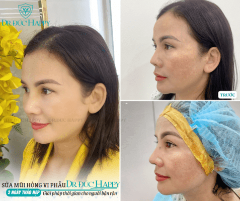 Kết quả case sửa mũi hỏng tại Dr. Đức Happy