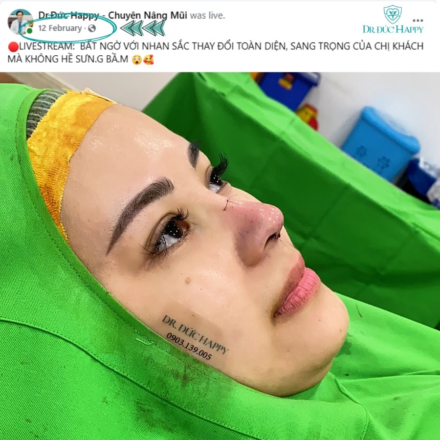 Khách Việt kiều Mỹ sau phẫu thuật mũi với Dr. Đức Happy
