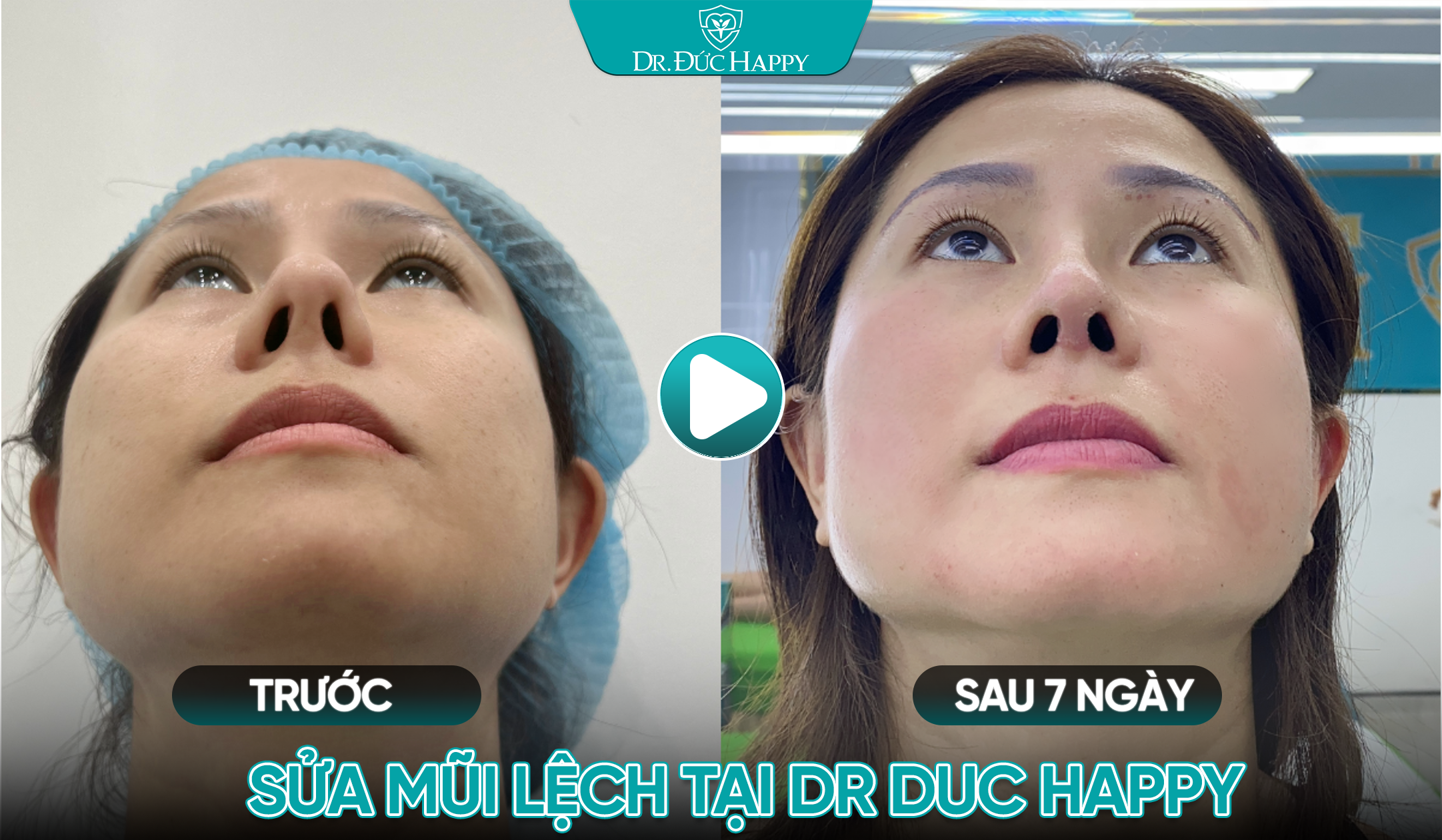 Khách hàng sửa mũi lệch tại Dr. Đức Happy