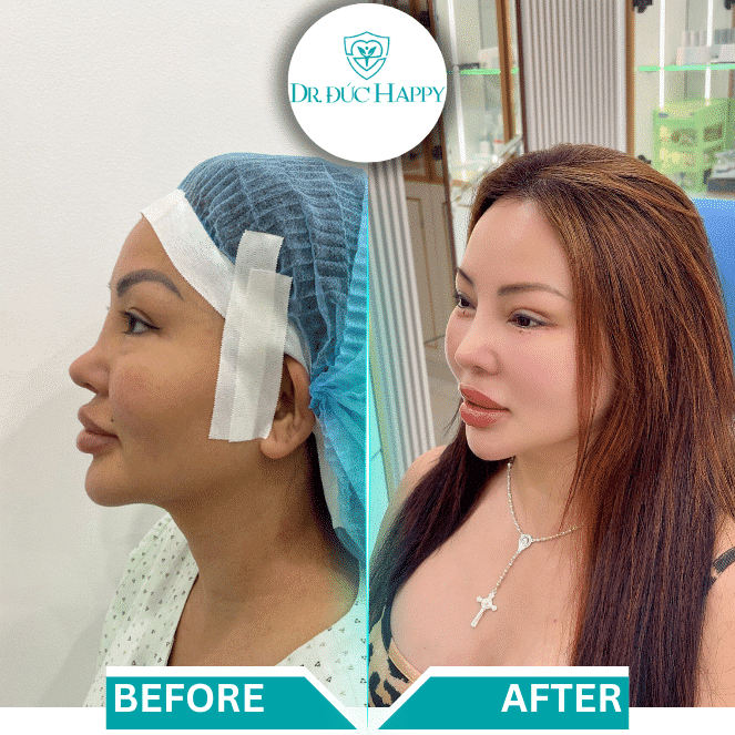 Case sửa mũi sụn sườn hỏng vi phẫu tại Dr. Đức Happy