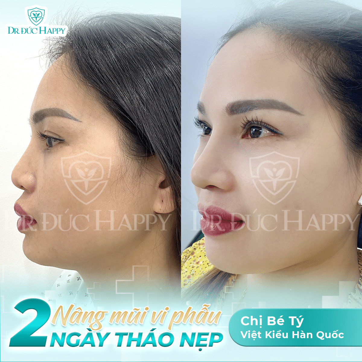 Chị Bé Tý một khách Việt kiều sau nâng sửa mũi tại Dr. Đức Happy