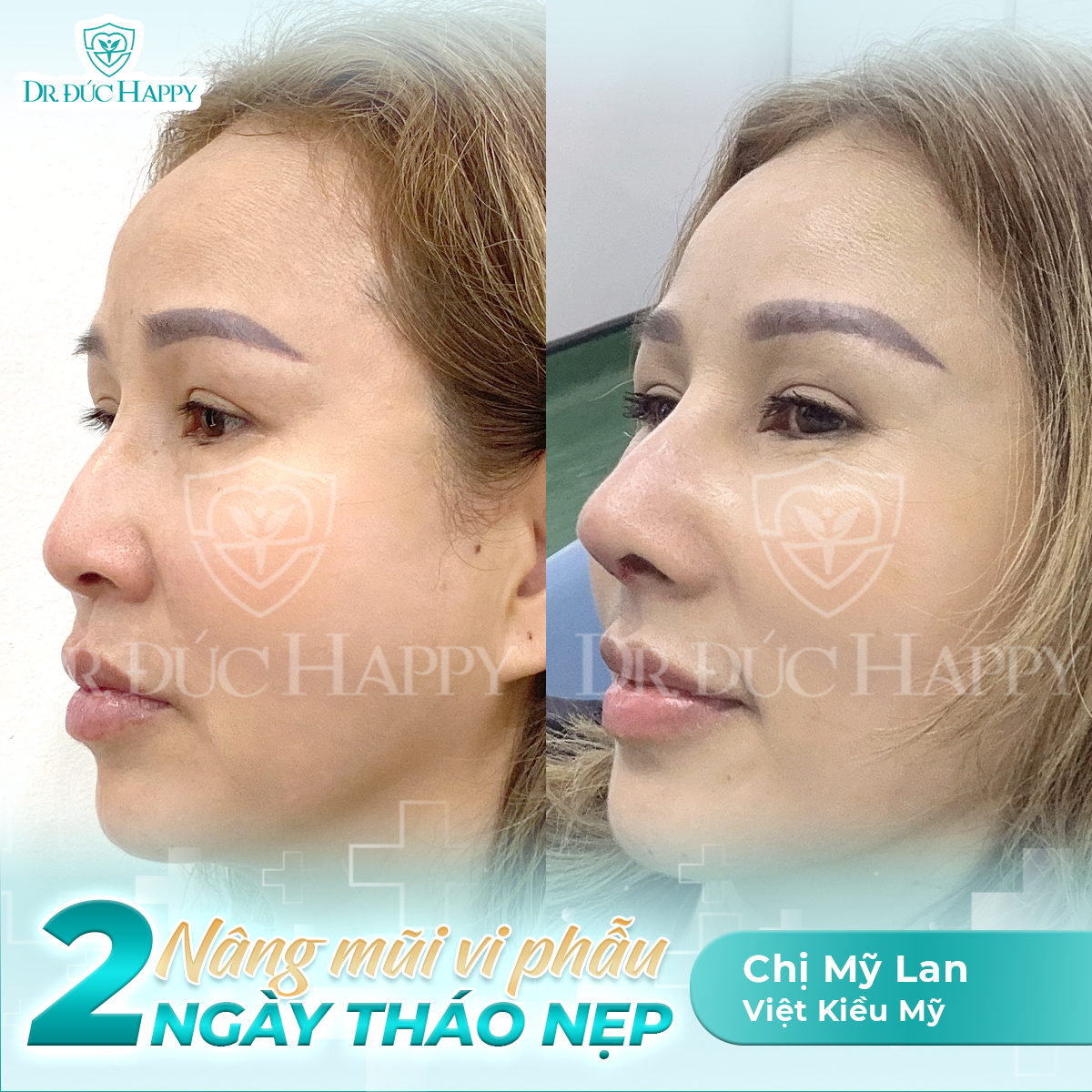 Khách Việt kiều Mỹ Lan sau nâng sửa mũi tại Dr. Đức Happy